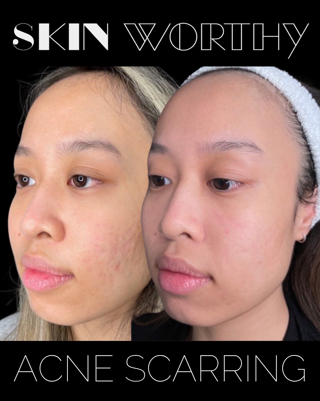 Acne scarring can be extremely burdensome. It can impact your self esteem, mental health and general wellbeing. There are so many treatments and products out there that promise results, but time and time again, patients are left with unsatisfactory results.
The SW difference:
While every patient is unique and requires an individualized assessment and plan, we have the tools and established protocols to help you achieve the skin you always wanted.
How? By combining modalities, treating multiple depths and different types of scars in the same appointment - all overseen by our medical director and dermatology certified Dr. Hemsworth.
If you’re ready to commit to a plan and say goodbye to acne scars for good, call or text 647-350-7546 right now.
