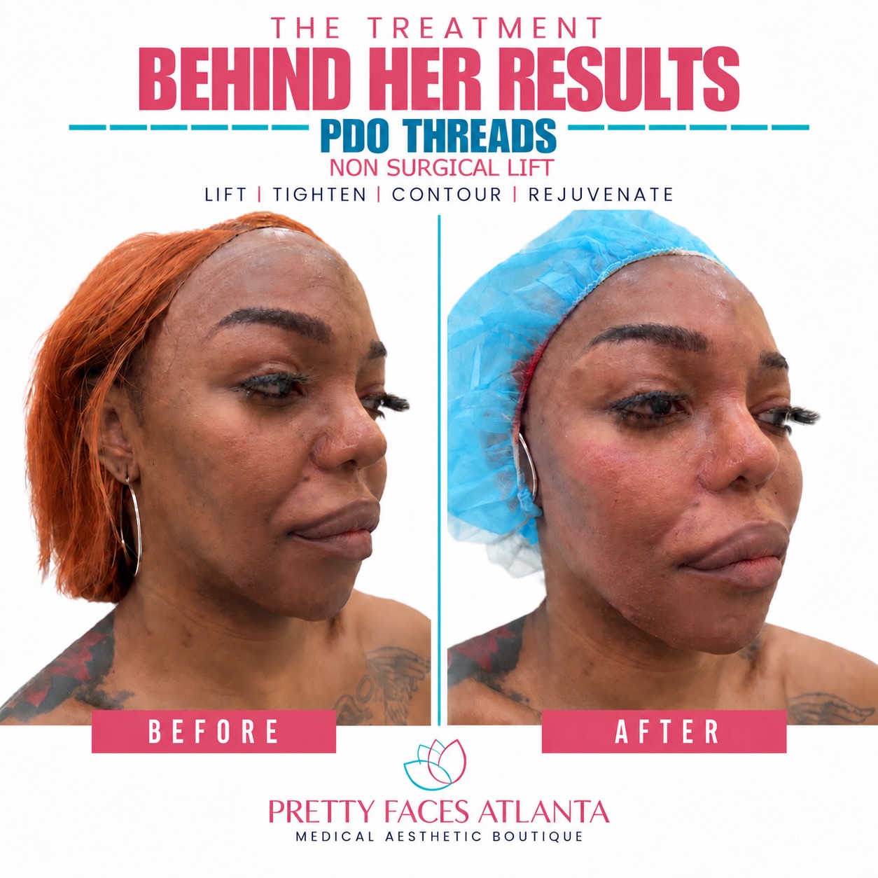 ✨ SNATCHED IS THE GOAL! ✨
Ready for a more lifted, defined, and SNATCHED look? 💕 September is the perfect time to refresh your look with our PDO Thread Sale!
🔥 $175 PER THREAD
🔥 8 Thread Minimum
🔥 SEPTEMBER ONLY
Lift. Define. SNATCH. 💉✨
Don’t wait—September appointments are filling up!
📍 Pretty Faces Atlanta
📲 Book your appointment today!
#PrettyFacesAtlanta #Snatched #PDOThreads #ThreadLift #SeptemberSale AtlantaMedSpa FacialRejuvenation AtlantaAesthetics BeautyGoals