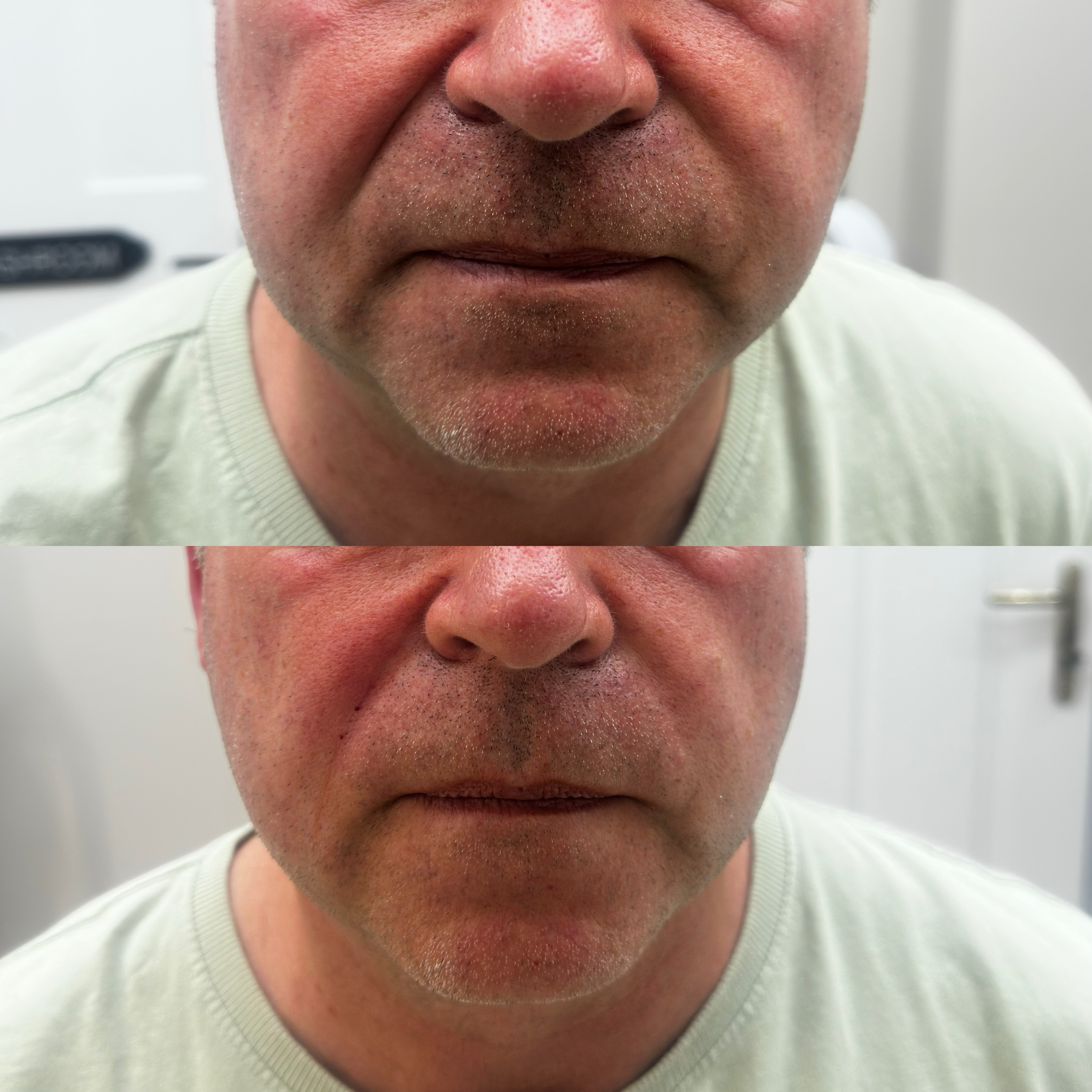 Softening the nasal folds giving a more youthful appearance 😍