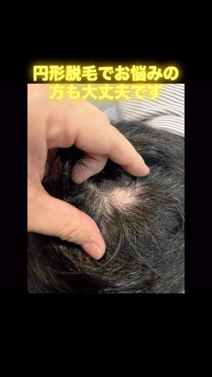 その薄毛、まずは“スカルプインク®“が自分に合うのか、から試しませんか?
当店では、皆様に安心して試していただけますように。初回施術で定着適性を見極め、万が一合わない場合は半額返金保証いたします。
無理に続けさせることはありません。結果に自信があるから、この仕組みです。
👉まずは“あなたに合うか”を確認してください。
【初回適正診断保証(半額返金)】
初回施術後、頭皮状態や色素の定着を確認し、当店基準で継続が難しいと判断した場合、初回施術費用の半額を返金いたします。
※以下の場合は対象外
・当店が継続可能と判断した場合
・お客様都合による中断など
・デザインの好みによる不満など
・アフターケア未実施など
──────────────────────
髪が薄くなると、見た目だけでなく気分まで沈みがち。
でも、もう一人で悩まなくて大丈夫です。
前髪・つむじ・分け目。
どこから見られても怖くない自然な仕上がりへ。
スカルプインク®は極小ドットで濃さを再現する
“最もバレにくい”頭皮タトゥー技術。
・痛みほぼなし/麻酔不要
・色落ちしにくい専用インク
・即日変化を実感/男女対応
産後脱毛・円形脱毛・傷跡にも対応。
──────────────────────
※美容師歴20数年の認定アーティストが責任を持って施術します。
※この地で開業18年となります、ご安心してお任せください。
大阪・和泉市|THREE BRANCHES
✨今なら3.3万発
49500円が33,000円(税込)
今なら何度でも‼️
📩公式LINEでご相談ください。
#スカルプインク
#薄毛対策
#SMP大阪
#スカルプインク大阪
#頭皮タトゥー大阪
※大阪で薄毛で悩まれている男性も女性も
ぜひ1度お声掛けください。