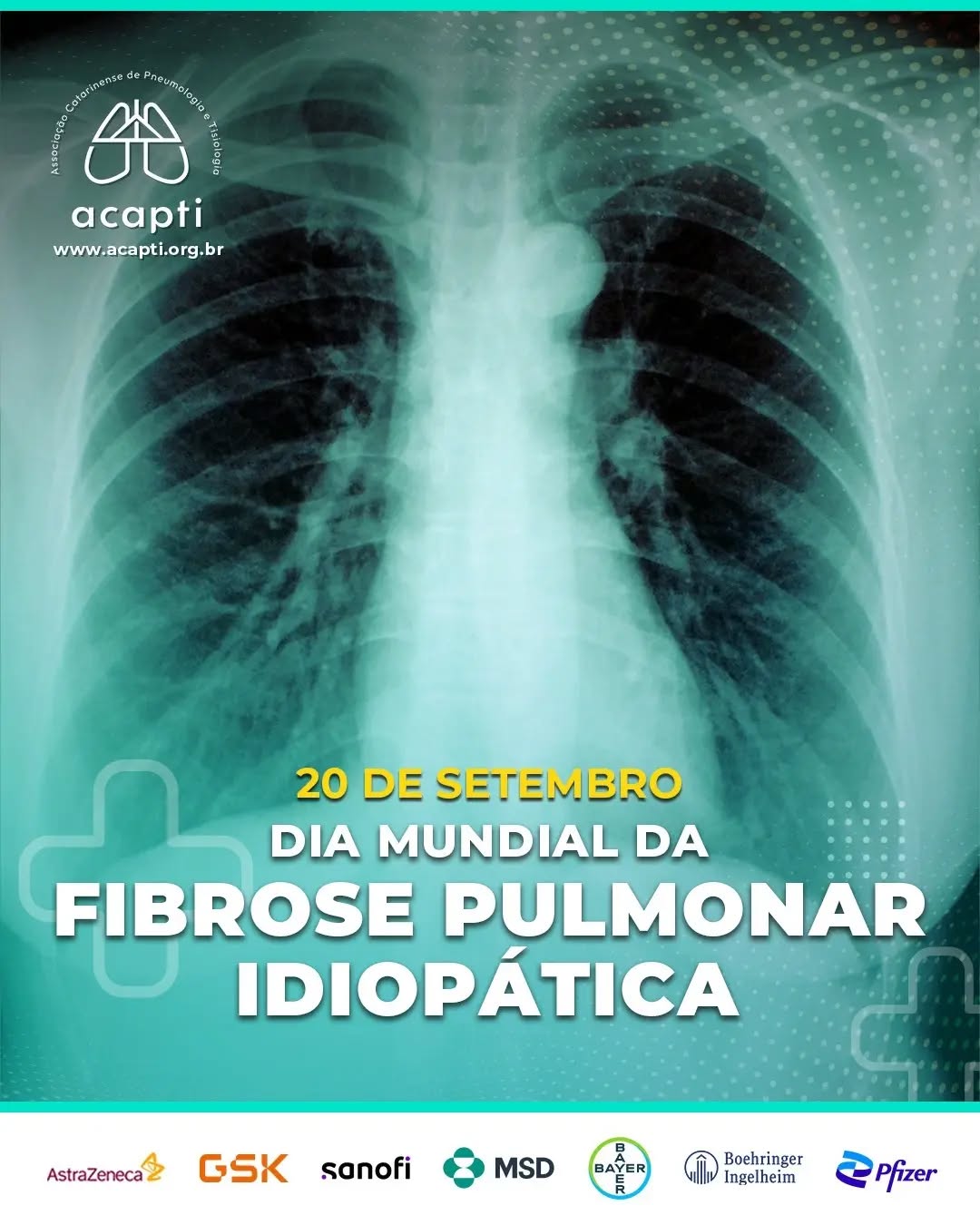 Dia Mundial da Fibrose Pulmonar Idiopática,
Hoje é um dia para ampliar a conscientização sobre a Fibrose Pulmonar Idiopática (FPI), uma doença rara, crônica e progressiva que afeta os pulmões e pode impactar profundamente a qualidade de vida.
Informação, diagnóstico precoce, acompanhamento médico e acesso ao tratamento são fundamentais para quem convive com a FPI.
Que esta data ajude a dar mais visibilidade à doença, fortalecer a rede de apoio e lembrar que, por trás de cada diagnóstico, existe uma história, uma família e uma pessoa que merece ser ouvida e cuidada.
Informar é também uma forma de cuidar.