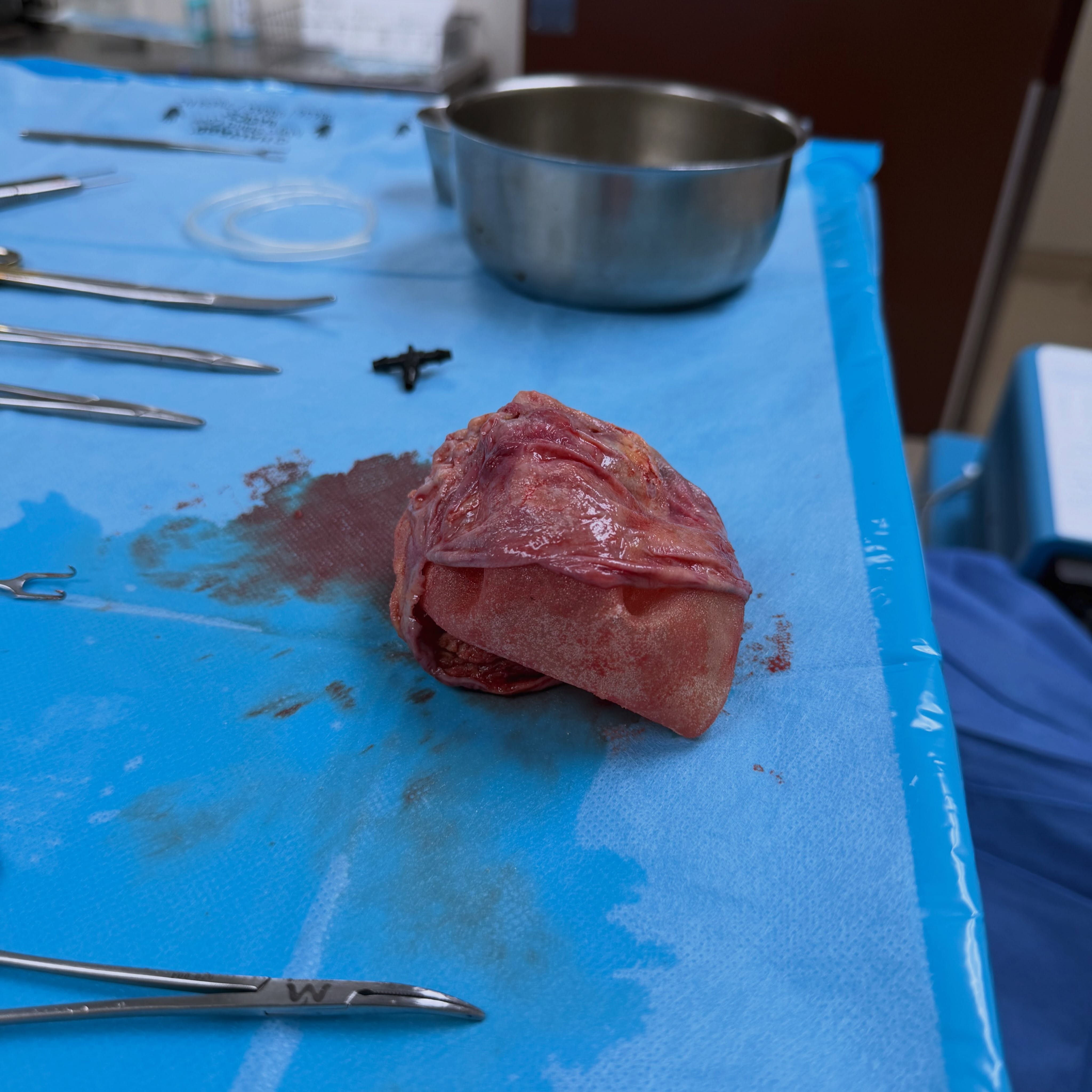 What you’re seeing 👀 — a breast implant surrounded by its capsule.
The body naturally forms scar tissue, called a capsule, around an implant. In some cases, that capsule can become thick, tight, or hardened, which may lead to discomfort or changes in the breast’s shape.
A little behind-the-scenes look at what we see in the OR. 🩺✨
#PlasticSurgery #BreastImplants #Capsulectomy #CapsularContracture #BehindTheScenes