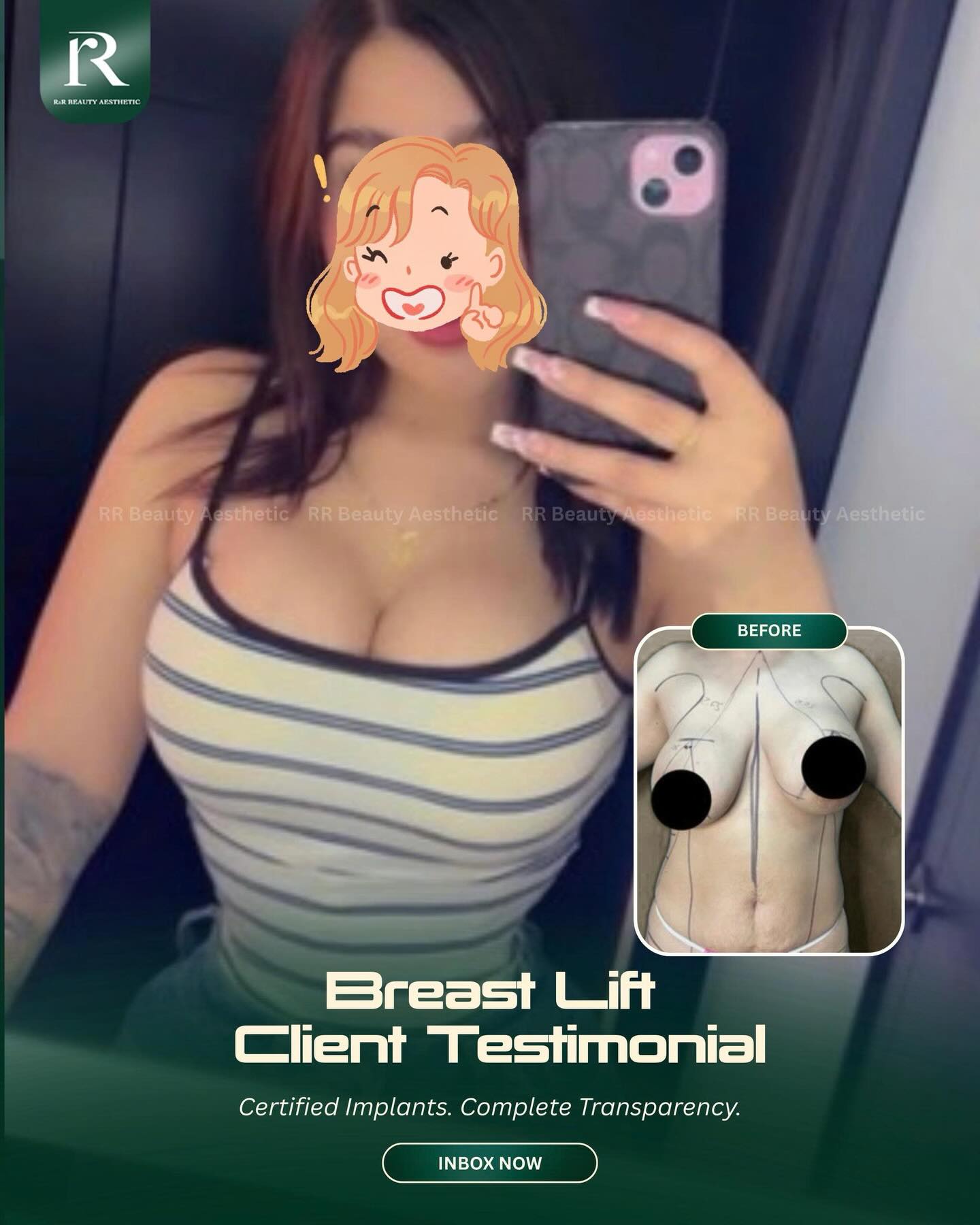 ✨ BREAST LIFT CLIENT TESTIMONIAL
✓ Lifts breasts affected by sagging
✓ Repositions the nipple and areola
✓ Restores a firmer and more youthful-looking shape
✓ Improves breast symmetry
✓ Refines stretched or downward-pointing contours
✓ Creates a more balanced upper-body silhouette
📩 Book Your Personalized Consultation Today
📞 Hotline: +84 777 777 787
📍 Vietnam Clinic - Plastic Surgery Center
R&R Beauty Clinic
10A Truc Duong, An Khanh Ward
Ho Chi Minh City, Vietnam
📍 Singapore Beauty Studio
R&R Beauty Studio
416 Ang Mo Kio Avenue 10
#01-985, Singapore 560416
.
.
.
#breastlift #clienttestimonial #mastopexy #saggingbreasts breastreshaping breastrejuvenation postpregnancybody bodyconfidence plasticsurgery rrbeautyaesthetic
breast lift client testimonial mastopexy sagging breast correction lifted breast shape nipple repositioning breast symmetry firmer contours post pregnancy breast changes body confidence cosmetic surgery Singapore Vietnam
