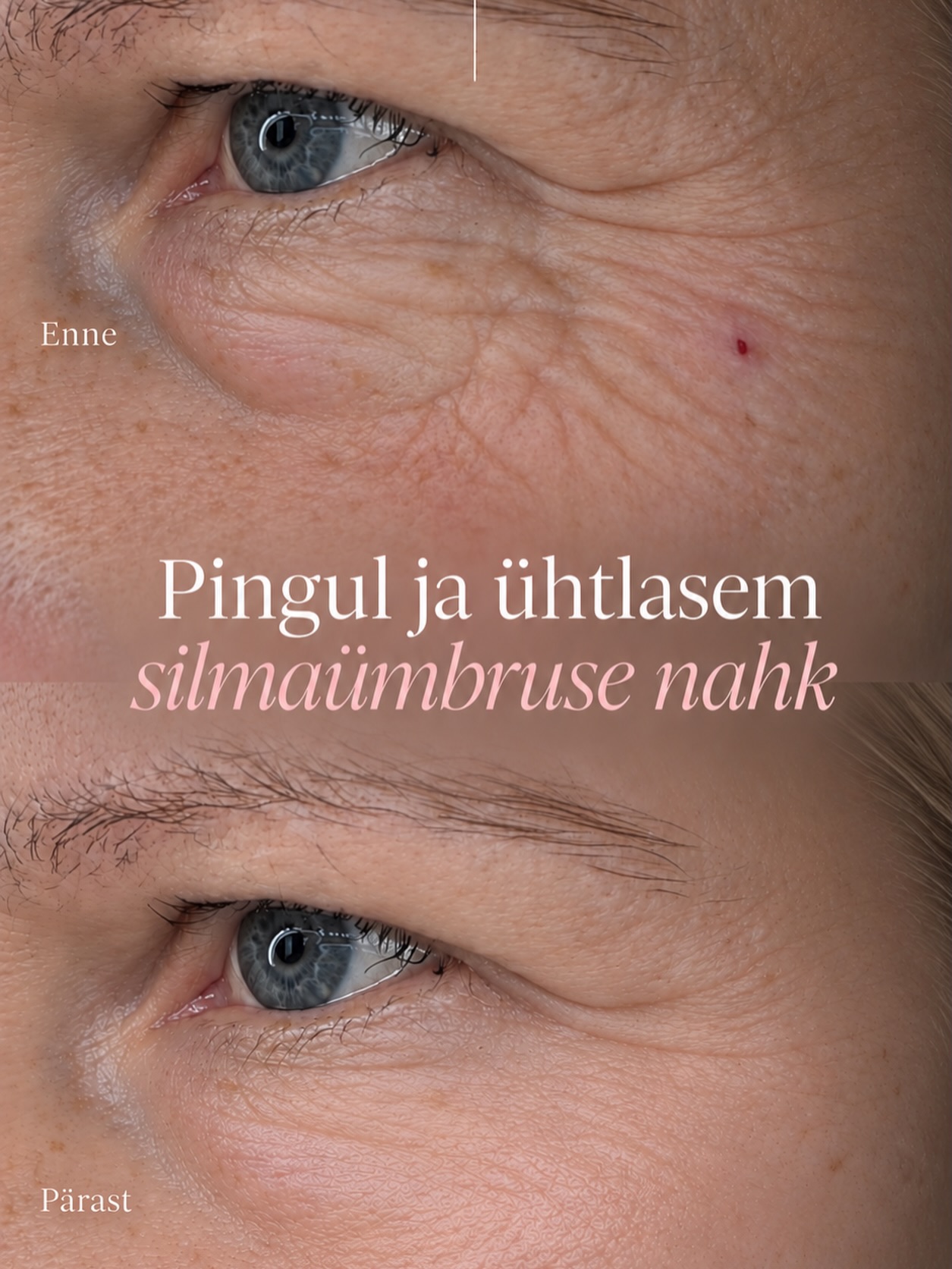 Pingul ja ühtlasem silmaümbruse nahk ✨
Silmaümbrus on üks esimesi piirkondi, kus hakkavad märkamatult avalduma naha vananemise märgid – nahk muutub õhemaks, elastsus väheneb ning tekivad peened jooned ja kortsud.
Õigesti valitud protseduuridega saame toetada naha uuenemist ja parandada selle kvaliteeti nii, et tulemus jääb loomulik.
Silmaümbruse naha protseduuride plaani võivad kuuluda näiteks Youlaser MT laserprotseduur, fraktsionaalne RF ning Xela Rederm 1,1%, sõltuvalt naha seisundist ja vajadustest.
Tulemused on individuaalsed. Sobiva protseduuri ja plaani valime konsultatsioonil.
MEDICINA KLIINIK
www.medicina.ee
#silmaümbrus #co2lasernoorendus #rfpinguldamine #botuliintoksiin #redermalisatsioon