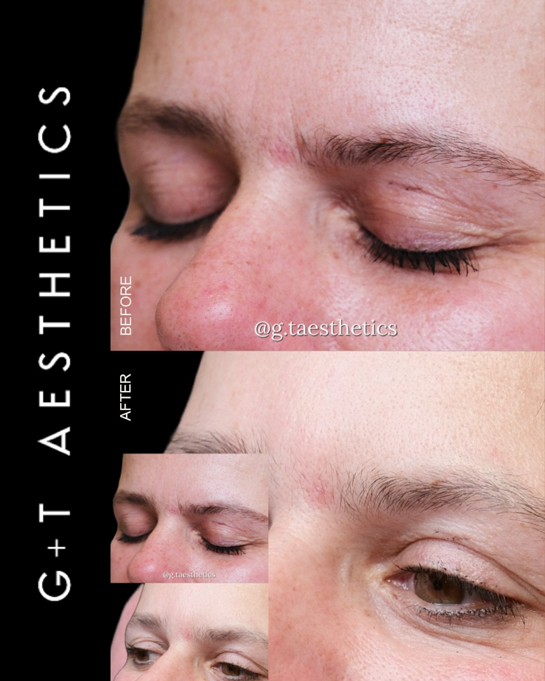 Frown lines can become more noticeable over time, creating a heavier or more tired appearance between the brows.
This before and after shows the result of carefully considered dermal filler treatment to soften the appearance of frown lines while maintaining natural facial movement and balance.
Every treatment at G&T Aesthetics begins with an individual assessment to determine the most appropriate approach.
📲Enquire or visit www.gtaesthetics.co.uk for more info.
#GTAesthetics #DermalFillers #FrownLines #FacialAesthetics #NaturalResults