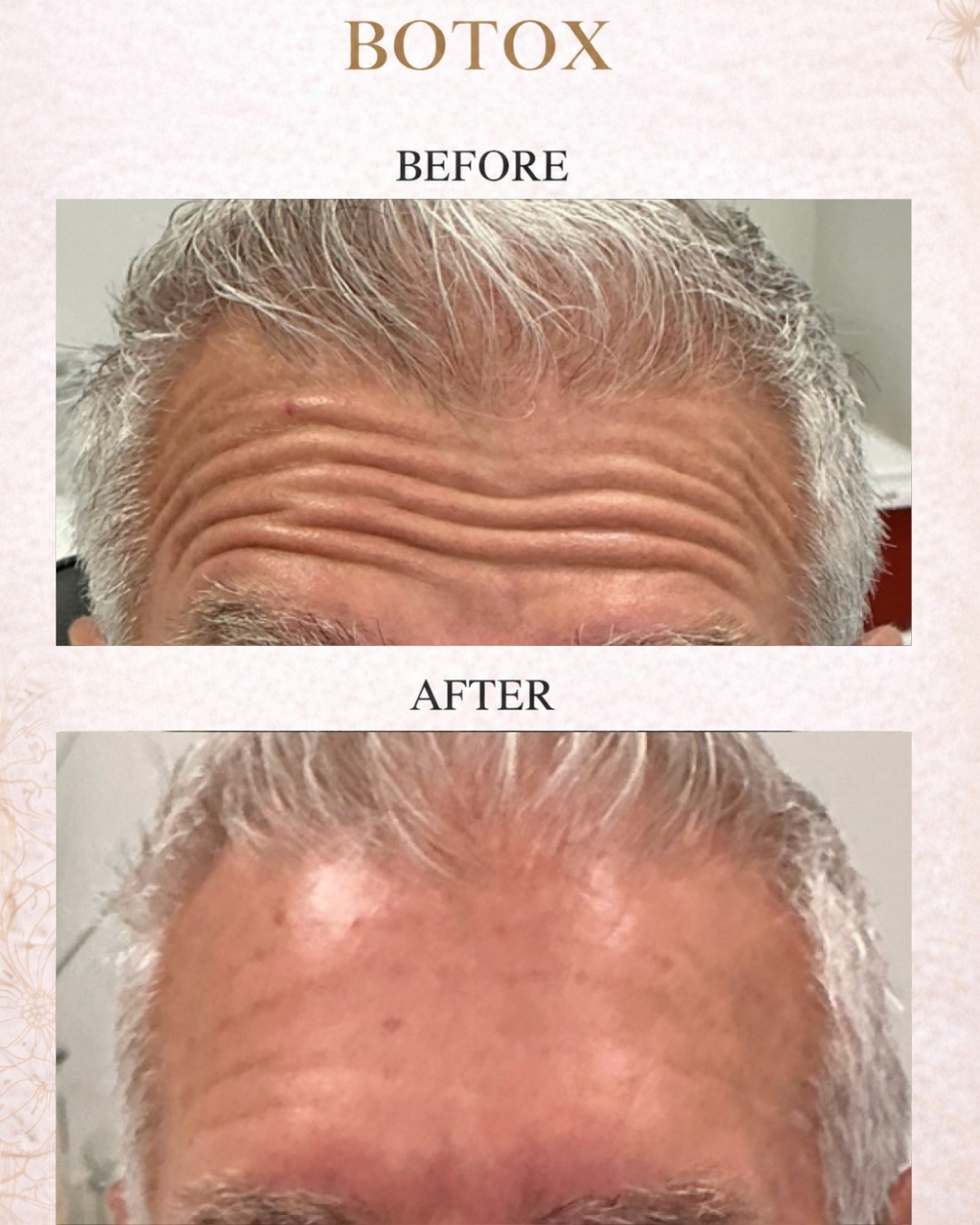 Botox isn’t just for women. 💉🔥
More men are choosing Botox to soften forehead lines, frown lines, and crow’s feet while still maintaining a natural, masculine appearance.
The goal isn’t to look “frozen”—it’s to look refreshed, confident, and well-rested.
Call or text today to book your appointment!
☎️ 239-448-3383
📩 chris.jewell@jewellmedicalspa.com
🌐 www.jewellmedicalspa.com | www.mrinjectable.com
📍 1044 Castello Drive, Ste 213 Naples Florida 34103
💳 We Accept Care Credit!
*
*
*
#botox #botoxinjections #botoxbeforeandafters #foreheadbotox #botulinumtoxin #injectables #cosmeticinjectables #aesthetics #beauty #naplesbeauty #naplesinjector #medspa #bestaestheticinjectors #beforeandafter