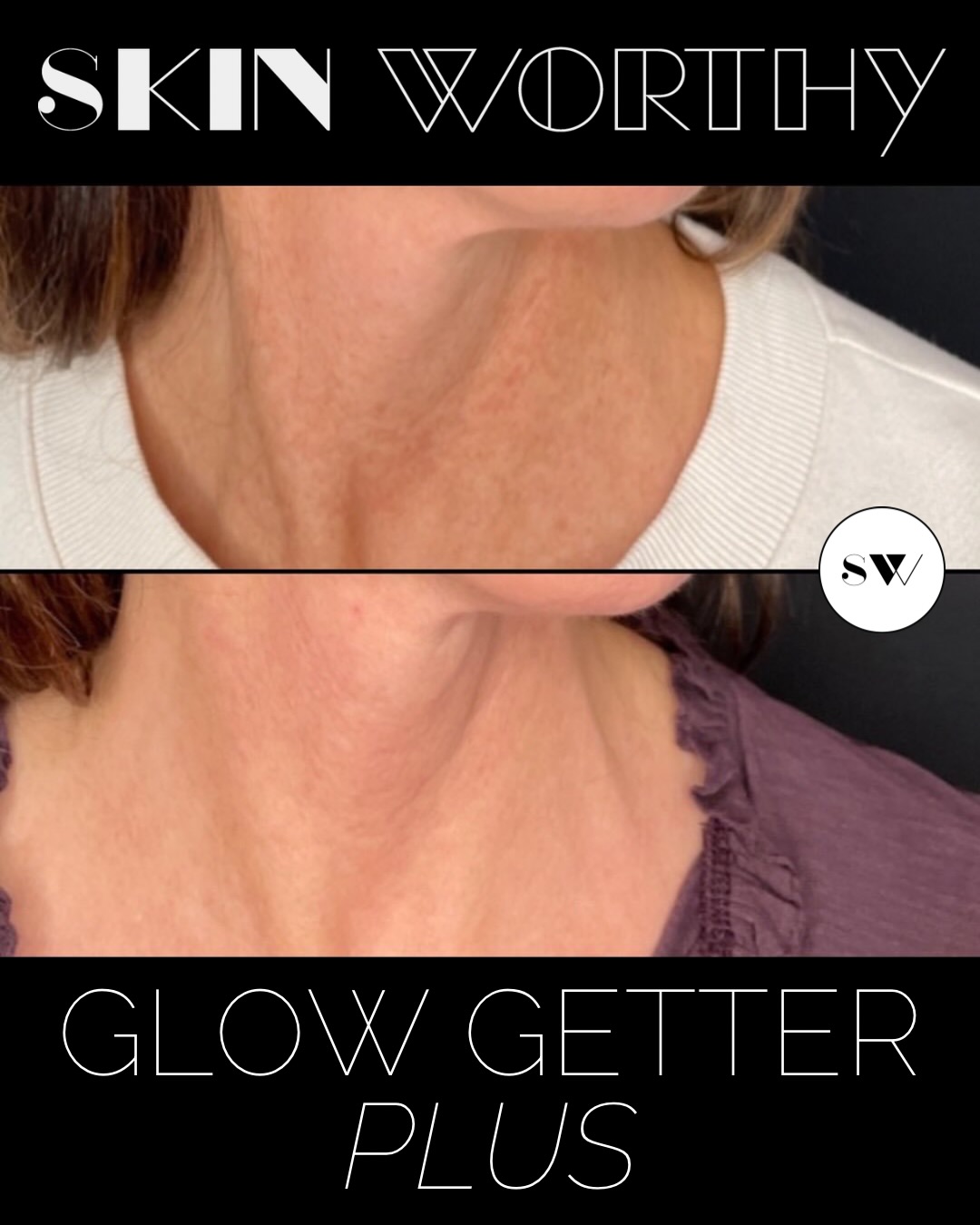 Our necks can show signs of aging and sun damage faster than our faces, yet they’re often left out of the treatment plan.
Glow Getter Plus is our most popular laser stack for the face, neck + décolletage, targeting pigmentation, pores, fine lines, texture and overall skin quality.
And sweater weather = laser weather. 🍂
Join us October 6th for our exclusive laser event with one-night-only savings on Glow Getter Plus and so much more.
Space is limited. DM us for details or to RSVP.