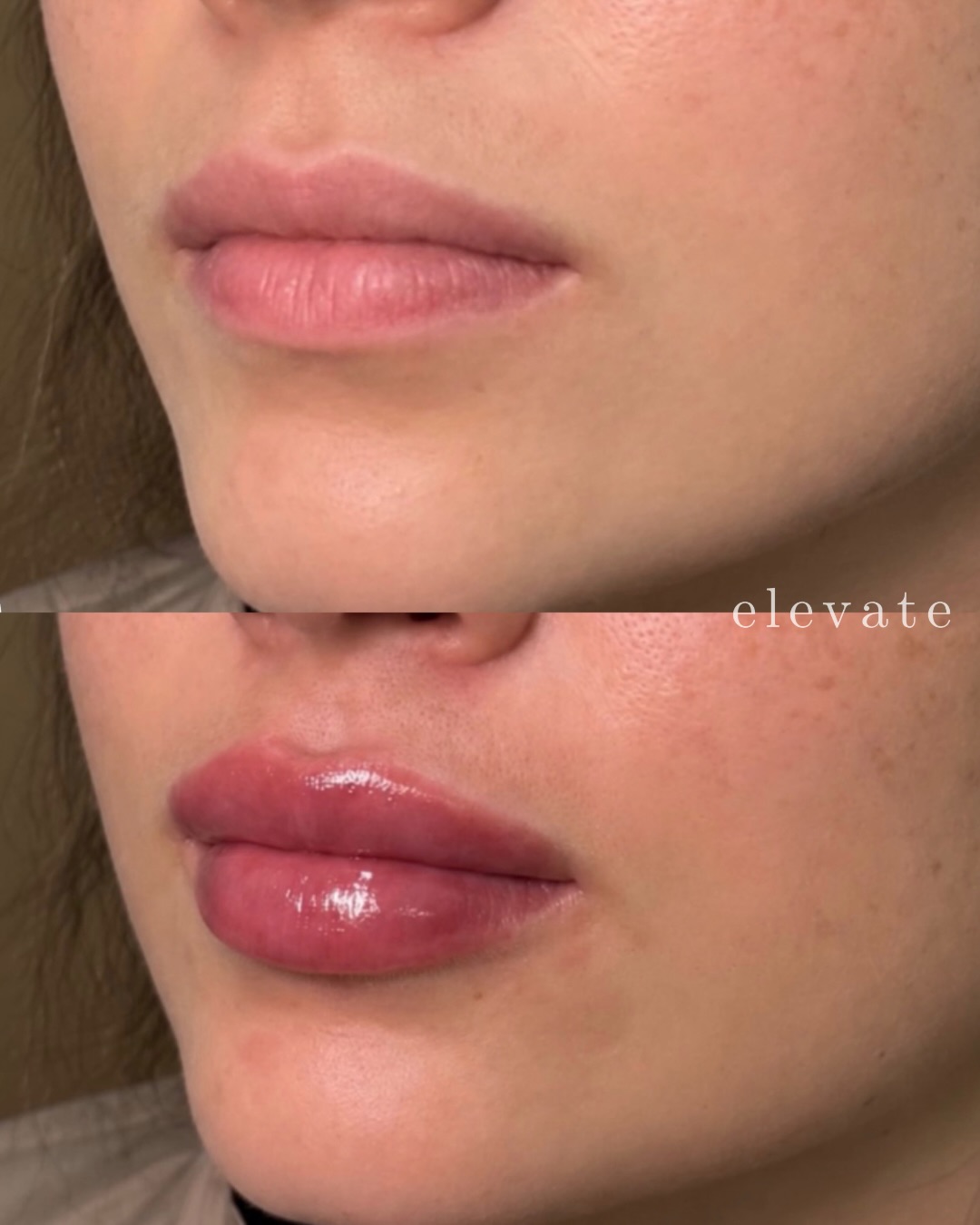Then vs now. 👄 Beautiful lip progress after a few sessions building volume + hydration without overdoing it. Slight bruising and swelling is expected and settles in about 2 weeks.
Treatment provider:
@injector_teena