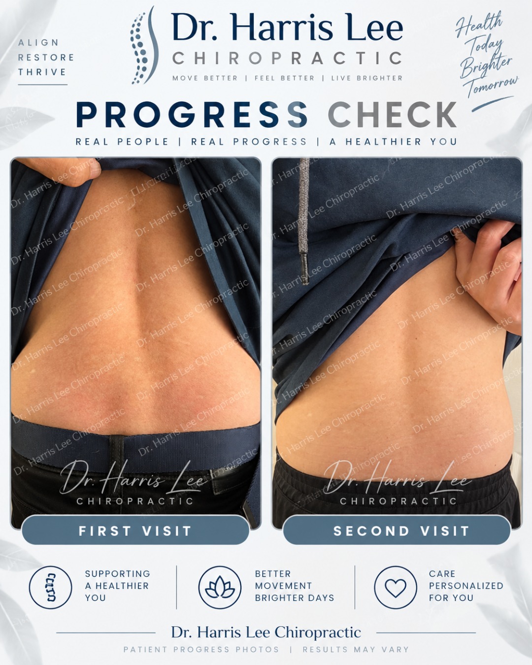 Progress in motion ✨
Just 3 days apart — a visual comparison from this patient’s first visit to the second visit.
This patient is receiving chiropractic care for lumbar spondylosis, a degenerative condition that can affect spinal mobility, stiffness, and comfort. These photos show changes observed over just 3 days as we continue to monitor posture, movement, and overall response to care.
Every treatment plan is personalized, and individual results may vary.
Patient photos shared with permission.
#DrHarrisLee #FremontChiropractor #Spondylosis #ChiropracticCare #SpineHealth