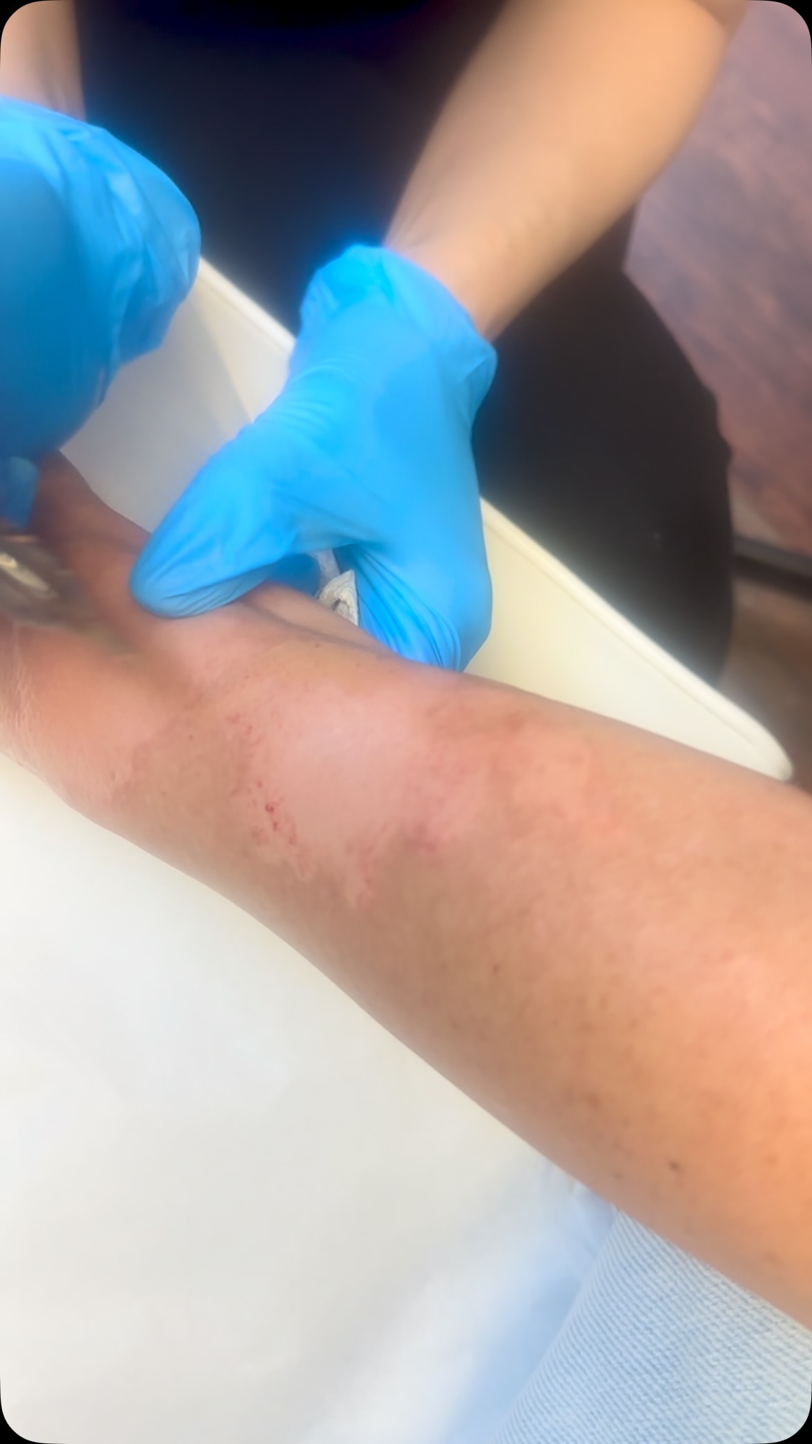 In this video, I’m working through one of the sessions in the camouflage process. This type of medical tattooing takes several sessions because we’re gradually building the color, adjusting the tone, and refining the blend as the skin heals between appointments.
Every area is different, and color can change during the healing process, so I work conservatively and build the pigment over time rather than trying to do everything in one session.
I always recommend speaking with your physician or dermatologist before tattooing an area affected by vitiligo, especially to make sure the condition is stable and tattooing is appropriate for you.
📍 St. Petersburg, Florida
Medical Tattooing • Scar Camouflage • Vitiligo Camouflage • Hypopigmentation
For appointments: ImagineYouNew.com
For professional medical tattoo training:
MedTattooEducation.com
#plasticsurgery #vitiligo #scarcamouflage #medicaltattooing #laser