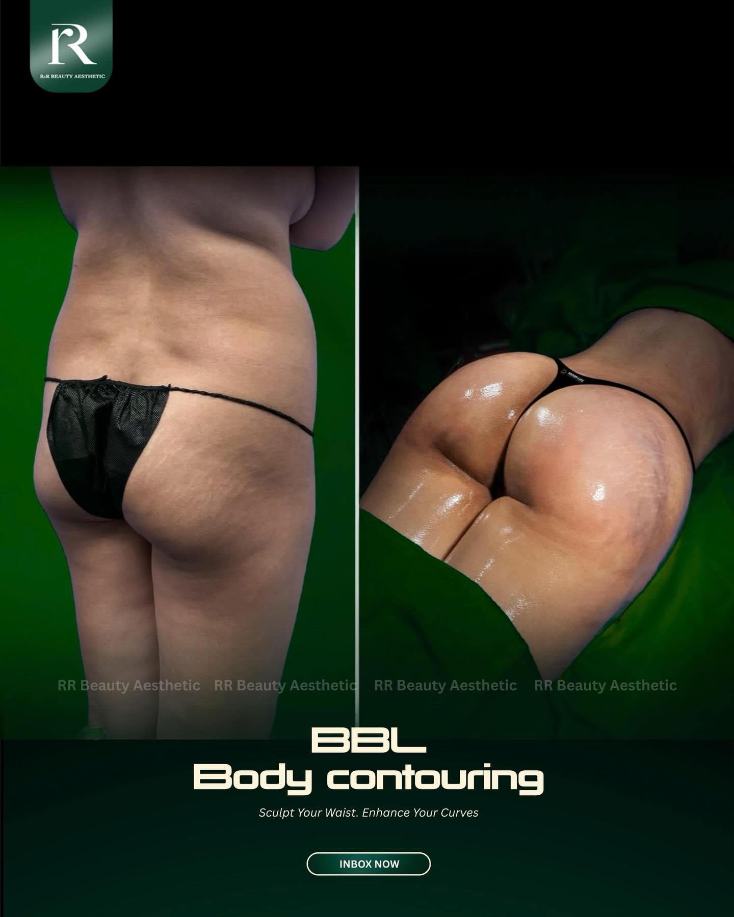 ✨ FLANK LIPOSUCTION & BBL — SLIM THE SIDES. SHAPE THE CURVES.
✓ Reduces stubborn fat around the flanks
✓ Adds volume to flat or under-projected buttocks
✓ Improves roundness and side-profile projection
✓ Refines uneven or hollow buttock contours
✓ Creates a more balanced hourglass silhouette
✓ Uses your own fat for personalized contouring
📩 Book Your Personalized Consultation Today
📞 Hotline: +84 777 777 787
📍 Vietnam Clinic - Plastic Surgery Center
R&R Beauty Clinic
10A Truc Duong, An Khanh Ward
Ho Chi Minh City, Vietnam
📍 Singapore Beauty Studio
R&R Beauty Studio
416 Ang Mo Kio Avenue 10
#01-985, Singapore 560416
.
.
.
#bbl #brazilianbuttlift #flankliposuction #fattransfer buttockaugmentation waistcontouring bodycontouring hourglassbody bodysculpting rrbeautyaesthetic
flank liposuction Brazilian butt lift BBL fat transfer slimmer waist fuller buttocks round buttock contour enhanced projection waist to hip definition hourglass silhouette body sculpting cosmetic surgery Singapore Vietnam