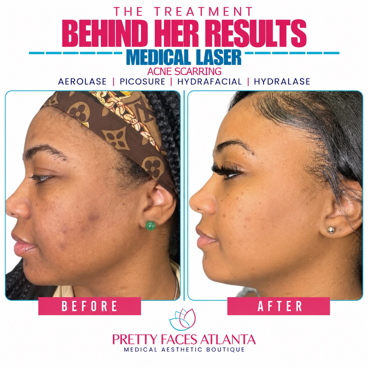 ✨ Healthy-looking skin starts with the right treatment! ✨
Medical Laser Treatments can help target hyperpigmentation, uneven texture, acne concerns, and overall skin rejuvenation—giving your skin the refresh it deserves. 💫
📲 Book your Medical Laser Treatment today!
#PrettyFacesAtlanta #MedicalLaser #LaserTreatment #SkinRejuvenation #AtlantaMedSpa