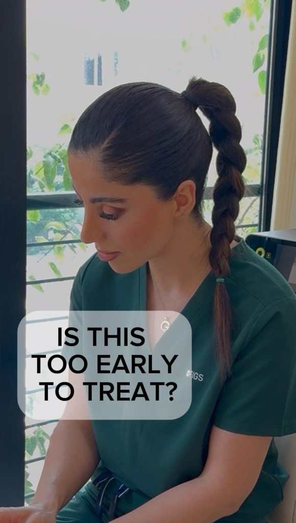 🔺There is a reason I like treating changes while they are still early:
✅the tissue itself usually has a better capacity to respond to treatment.
👉🏽In this case, we are seeing a small localized fat pocket under the chin together with the beginning of skin laxity and jowling — enough to start reducing the definition of the jawline, but still at an early stage.
🟢This is a great stage for non-surgical treatment because we can work on three things at the same time: improve what is already there, support the tissue while the changes are still early, and potentially reduce how quickly those visible changes become more pronounced.
❌It is very different from waiting until the laxity becomes advanced and then trying to correct it.
💡Sometimes the best time to start is when you first notice the change — not when it has already become a major concern.
.
.
.
#jawline #facecontour #doublechinremoval #endoliftdubai #endolift