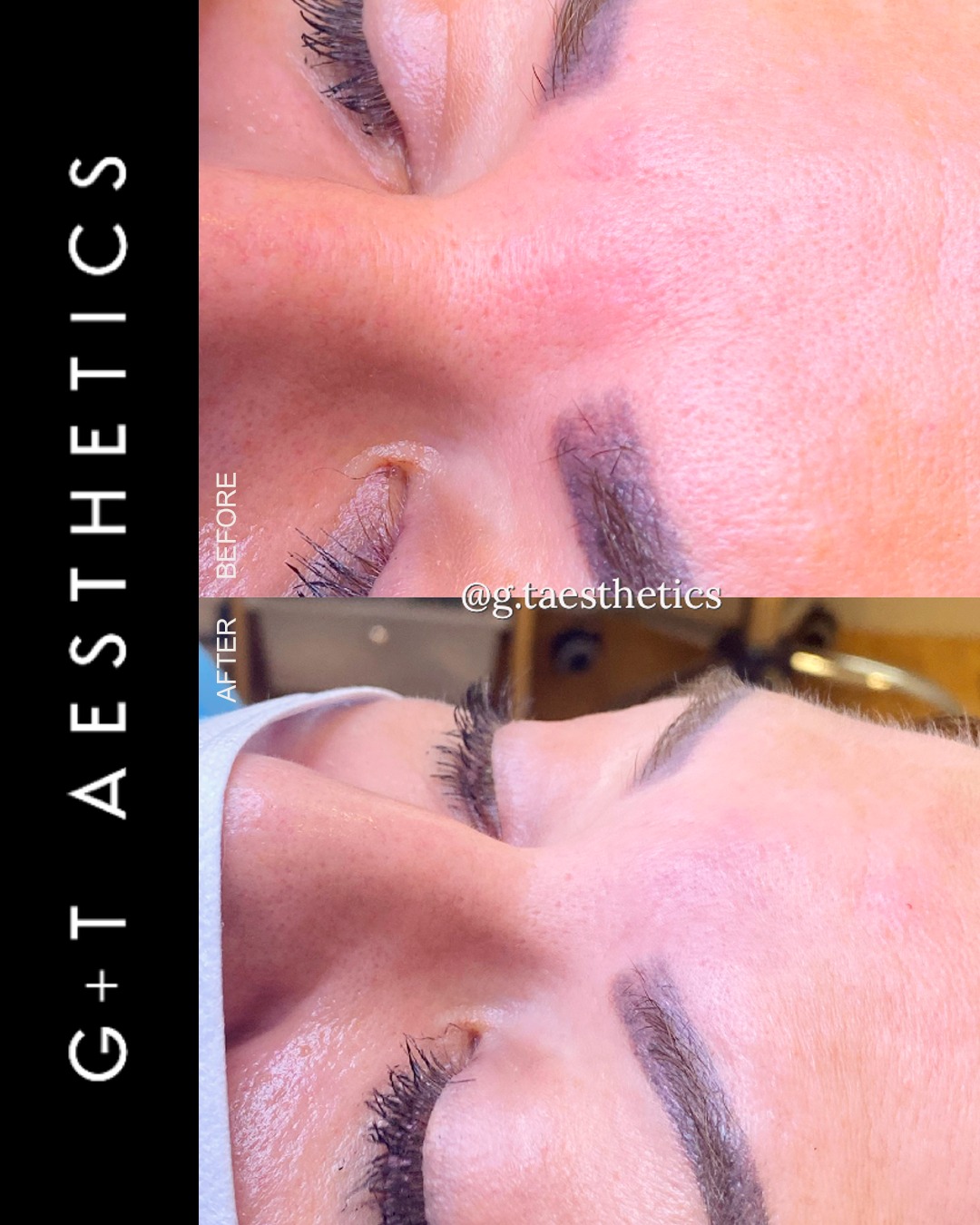 Frown lines can become increasingly visible over time, particularly between the eyebrows.
This before and after shows the result of dermal filler treatment to soften the appearance of the area and restore a more balanced look.
As with all treatments, the approach is carefully assessed and tailored to the individual rather than following a standard treatment plan.
📲Enquire or visit www.gtaesthetics.co.uk for more info.
#GTAesthetics #FrownLines #DermalFillers #FacialAesthetics #BeforeAndAfter