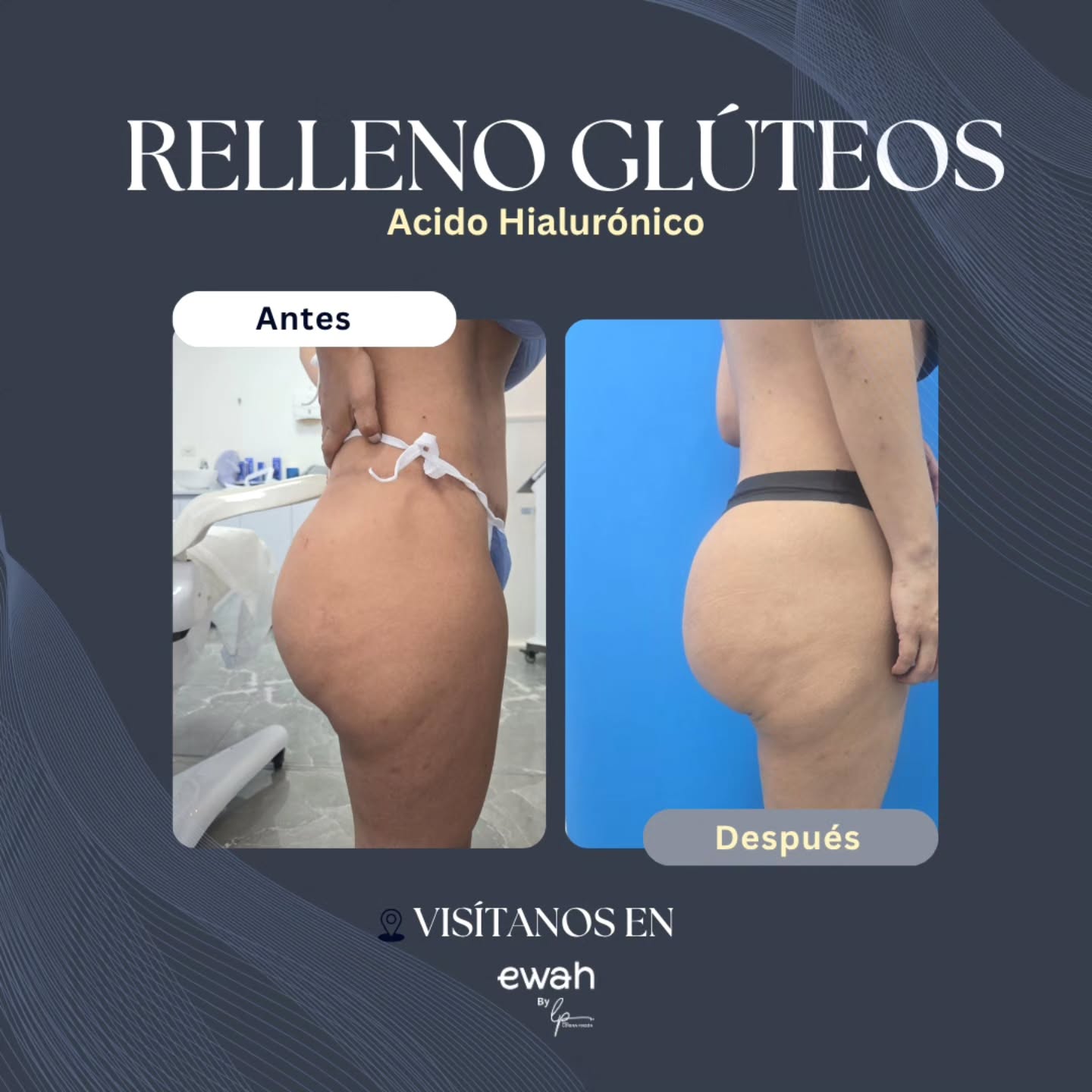 Aumento de gluteos en Bogotá sin cirugía🍑
Quieres resaltar tus curvas naturales sin pasar por el quirófano? ✨
⬇️Olvídate de las cirugías, las anestesias generales y los largos procesos de recuperación.
Con nuestro tratamiento de Aumento de Glúteos con Ácido Hialurónico, logramos un aspecto más firme, redondeado y armónico de forma Inmediata.
Además, nos enfocamos en rellenar los famosos hip dips (esos hundimientos laterales que a veces nos quitan confianza) para lograr una silueta mucho más simétrica y estilizada.
🍑¿Lo mejor de este tratamiento?
Resultados inmediatos y de aspecto muy natural.Procedimiento ambulatorio (sales caminando directo a tu rutina).
Ácido hialurónico de alta densidad, seguro y biocompatible.
Dile adiós a las inseguridades y dale la bienvenida a tu mejor versión. 💖📲
¿Lista para agendar tu valoración?
Déjanos un comentario con la palabra CURVAS o escríbenos directamente al link de nuestra biografía para enviarte toda la información por DM.