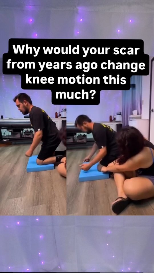 Sometimes the area that needs attention isn’t the muscle you keep stretching.
Scar tissue doesn’t just involve the skin and tissue underneath it as it affects the nerves and arteries in which it weaves around. It can also change the sensory information your brain is receiving from that area.
So before trying to force more range of motion, I wanted to see what happened when we changed the sensory input coming from her scar.
A little hands-on input.
Then we reassessed.
And his knee moved differently.
That doesn’t mean every scar is limiting your mobility or that touching a scar will magically improve your range of motion.
But it’s a great example of why I’m always looking beyond “this muscle is tight.”
Your brain is constantly using sensory information from your body to decide how much movement feels available, safe, and useful.
Sometimes changing the input can change the output. 🧠
I'm Sara Becker, neuro physical therapist, and I help medically dismissed adults understand and ease their symptoms through the lens of neurology.
✨ Follow @Releaseology for more weird connections between your brain, body + symptoms.