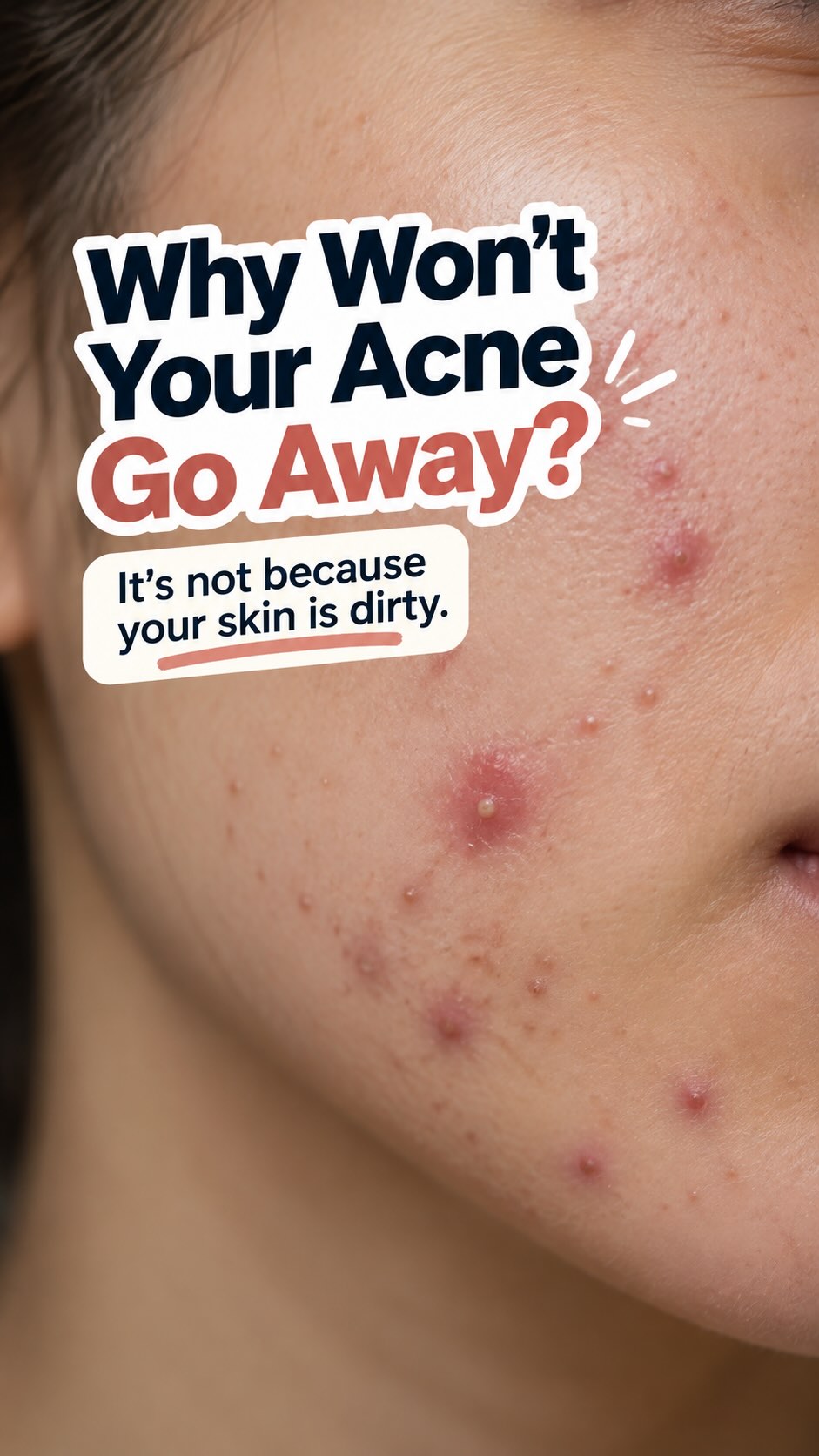 Acne isn’t a hygiene problem. So, scrubbing harder isn’t the answer.
Trifarotene is a topical retinoid that helps regulate skin cell renewal and prevent clogged pores and new breakouts.
If you’re new to it, start gently. A thin layer at night, moisturiser to help with dryness, and sunscreen every morning.
Treat the acne, don’t punish your skin.
#Acne #AcneTreatment #Trifarotene #dermatology