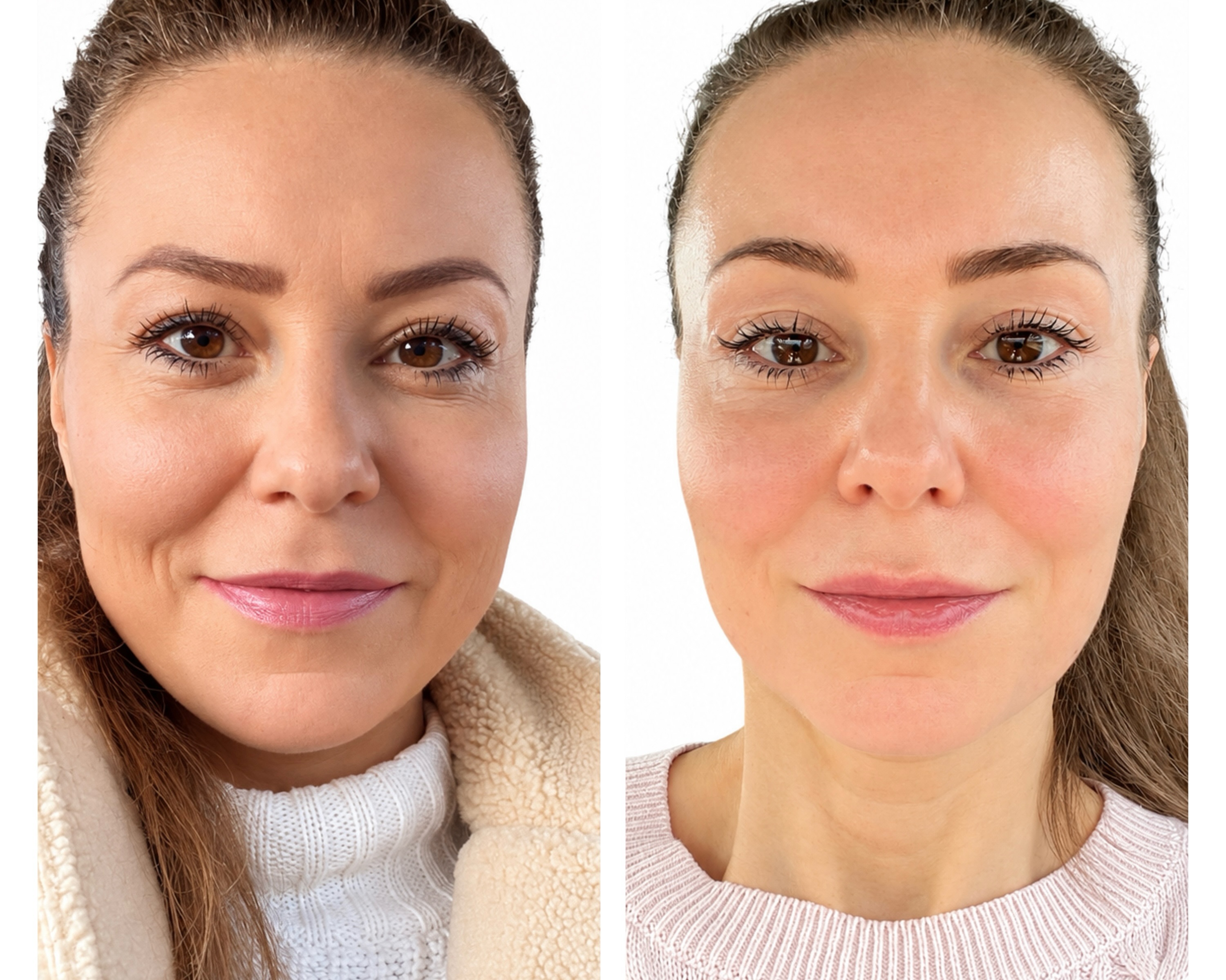3D Lifting😍
Das Ergebnis ist nur nach einer Behandlung und circa drei Monaten.
Die Ergebnisse halten circa zwei Jahre.
Hautstraffung, Vorhernacher, Facelifting
#antiaging #vorhernacher
Wie findest du das Ergebnis?