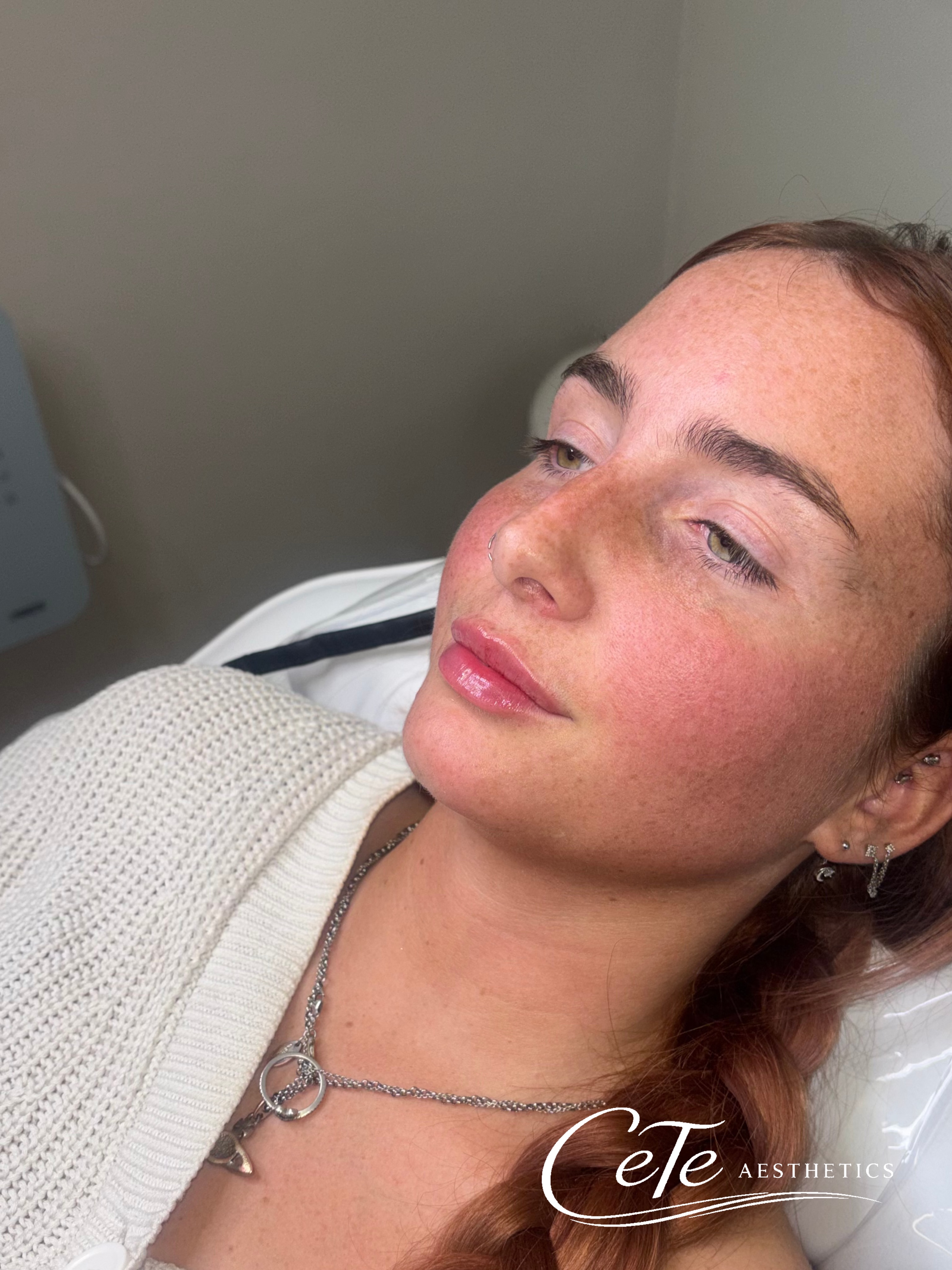 0.5ml lip enhancement π€
A subtle enhancement to add a little fullness, improve definition and balance the natural shape of the lips.
ββ
πππππππ πππ ππππππ & ππππππππ
π Schedule your appointment on our website - www.ceteaesthetics.co.uk
π² Direct message
π§ chloe@ceteaesthetics.co.uk
πCeTe Aesthetics, 278 Ashby High Street, DN162RX