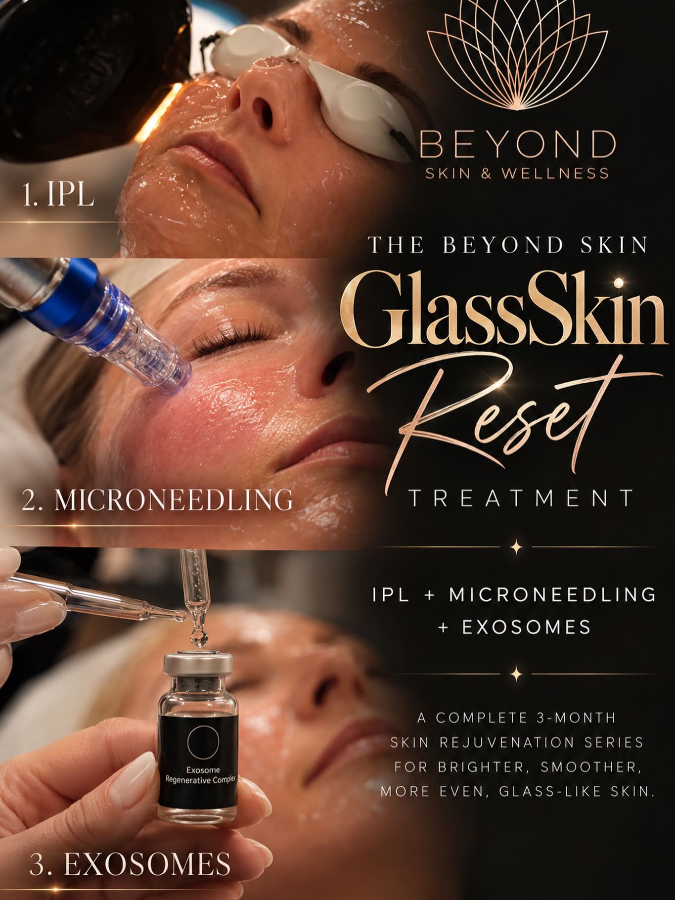 ✨ NEW SERVICE ALERT ✨
Introducing the Beyond Skin GlassSkin Reset Treatment 💎
A powerful 3-month skin rejuvenation series combining:
⚡️ IPL
✨ Microneedling
🧬 Exosomes
Each monthly treatment is designed to improve sun damage, pigmentation, redness, pores, fine lines, texture and overall skin quality — for brighter, smoother, more even, glass-like skin. ✨
🤍 3 treatments, spaced 1 month apart
🤍 Face + neck included
🤍 Exosomes included with every treatment
🤍 Chest add-on available
Three advanced treatments. One appointment. Three months of progressive skin renewal. 🖤✨
📲 Message us to book your GlassSkin Reset consultation or book via link in bio
#BeyondSkinAndWellness #GlassSkinReset #GlassSkin #IPL #Microneedling Exosomes SkinRejuvenation OcalaMedSpa OcalaSkincare