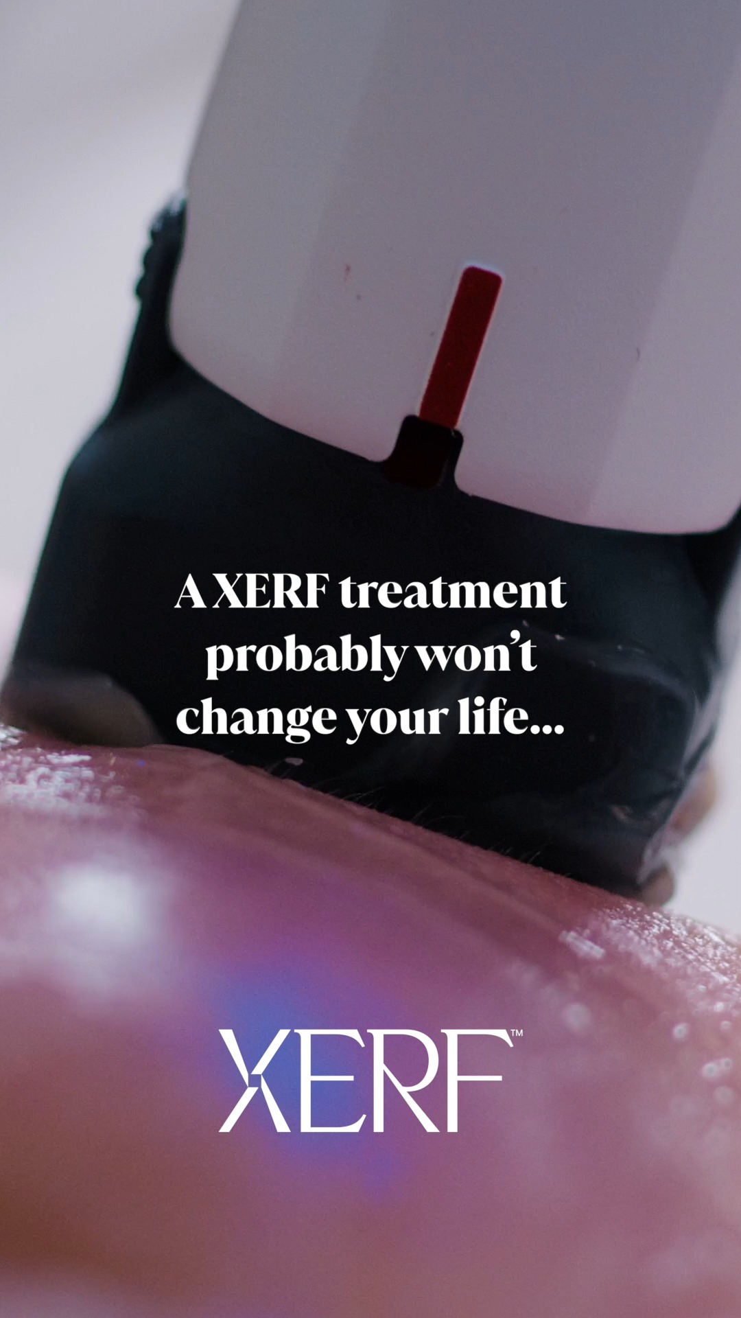 ✨ Consider this your sign. ✨
Sometimes doing something just for you is reason enough. 🤍
XERF is designed to help improve the appearance of skin laxity while supporting collagen remodeling for skin that looks firmer, smoother, and more defined—with natural-looking results that continue to develop over time.
And since we’re officially bringing XERF to Lakes Area IV Wellness & Aesthetics, we’re making the timing even better. 👀
🔥 SAVE $500 on your XERF treatment package with our pre-launch pricing through September 30th!
A little self-care. A little collagen. A little “why didn’t I do this sooner?” 😉
📲 Reserve your package and lock in pre-launch pricing! 218-454-5248
#XERF #SkinTightening #CollagenBoost #BrainerdLakesArea #LakesAreaIVWellness