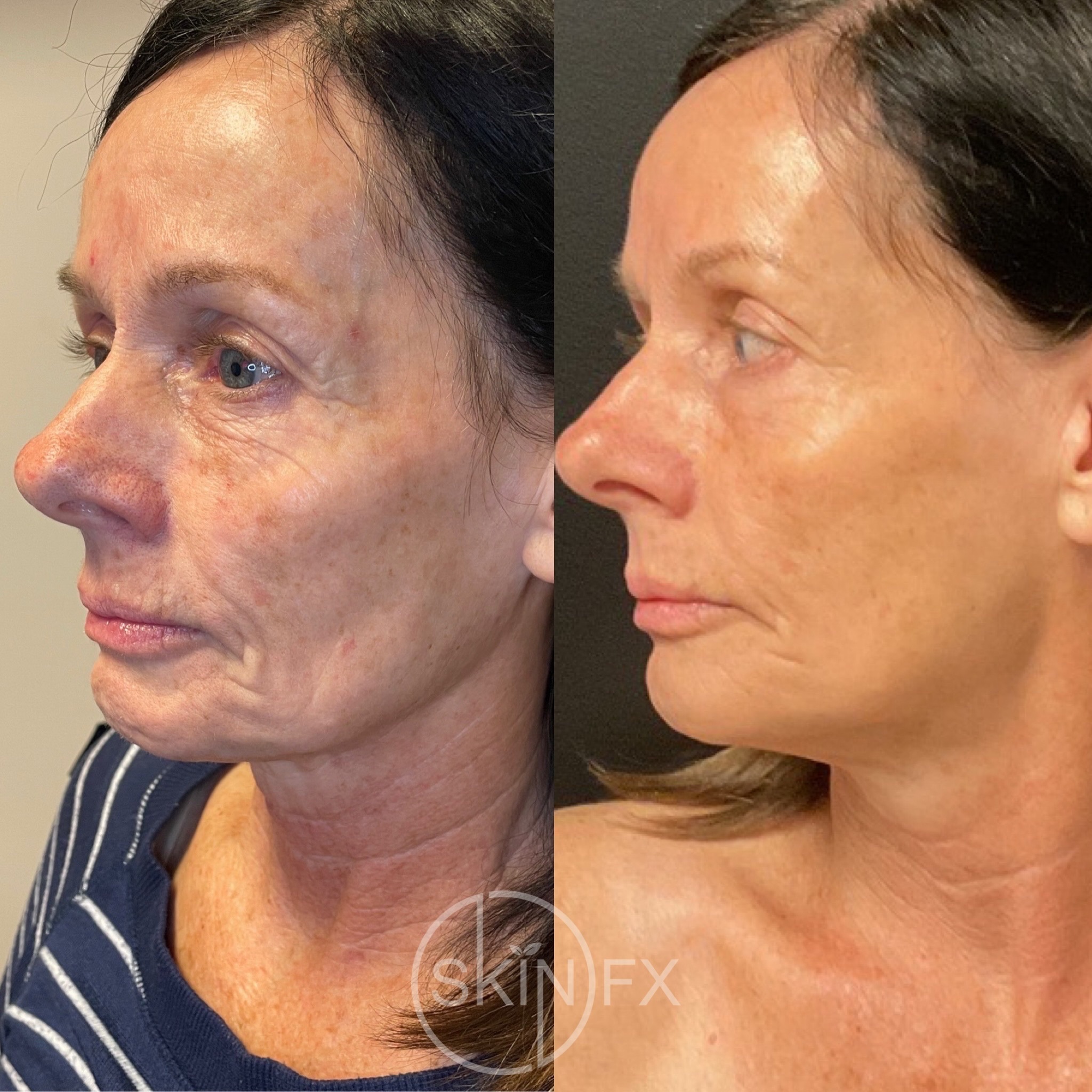 How much Sculptra do you need? It depends!
Your age, goals and individual skin all factor into your treatment plan. A common guideline is 1 vial per decade of age, but your provider will customize it to you.
#skinfx #skintransformation #sculptra #utahmedspa
