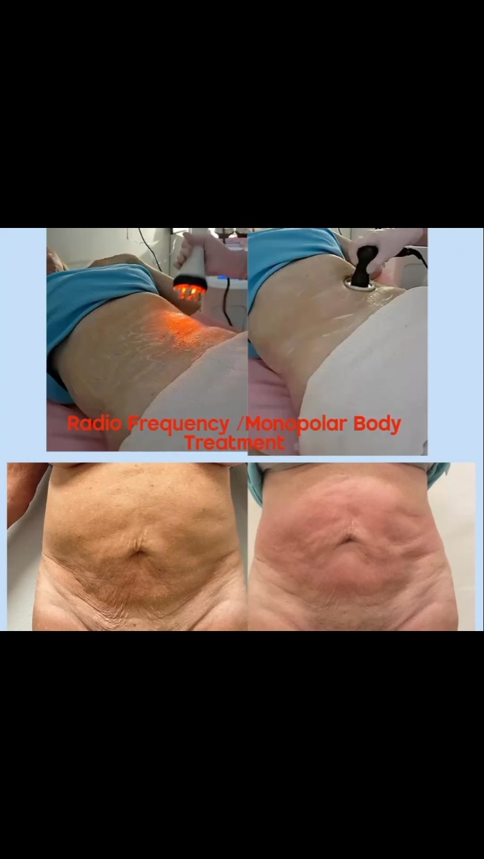 2 TREATMENTS DONE 2 TO GO …STAY TUNED FOR FINAL RESULTS.
Thermal Energy: Devices deliver controlled heat (typically 40-45°C) into the dermis and subcutaneous fat layers.
• Collagen Boosting: The heat instantly contracts existing collagen fibers and triggers a long-term healing response that generates fresh collagen and elastin over 2 months.
• Fat and Cellulite Reduction: Deeper-penetrating RF waves can help metabolize fat cells and improve local blood circulation to smooth out the appearance of cellulite.
#capricebeautybar #sarasotabodycontouring #sarasotaflorida #sarasotahifu #age
Capricebeautybar.com