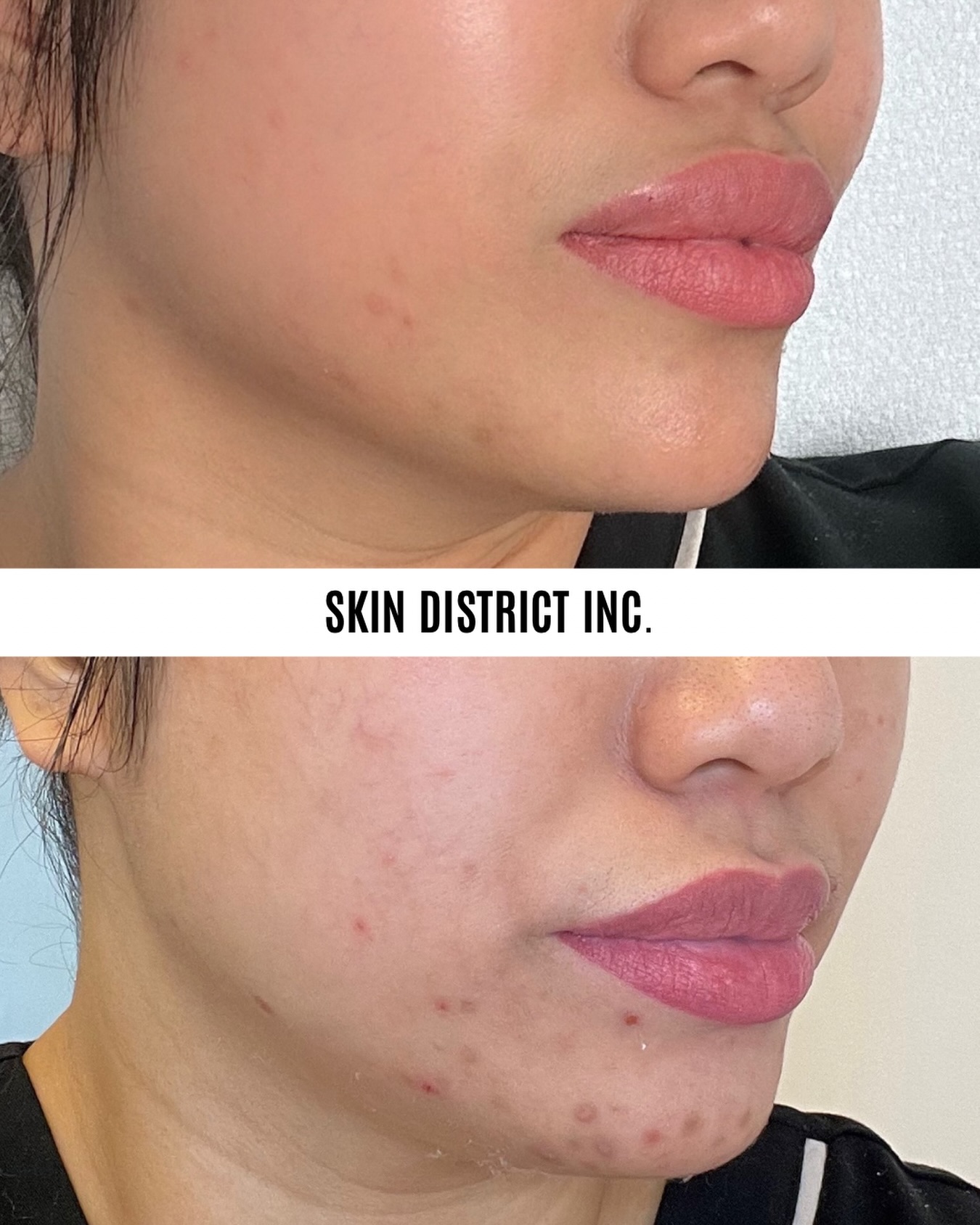 6 sessions. Real skin. Real progress. 👏🏼
Acne scarring doesn’t change overnight — but when microneedling is done right and done consistently, the skin can do some pretty incredible things.
This client completed 6 microneedling sessions, giving her skin time between treatments to heal, remodel and build new collagen.
The goal isn’t “perfect” skin. It’s healthier skin with:
✨ Smoother texture
✨ Softened acne scarring
✨ More even-looking skin
✨ Continued collagen remodeling over time
When it comes to acne scars, consistency beats the quick fix. 🤍
Want to know if microneedling is right for your acne scarring? Send us a DM with “SCARS” and we’ll help you build a treatment plan.
#Microneedling #AcneScars #AcneScarTreatment #SkinTransformation #MapleRidgeBC