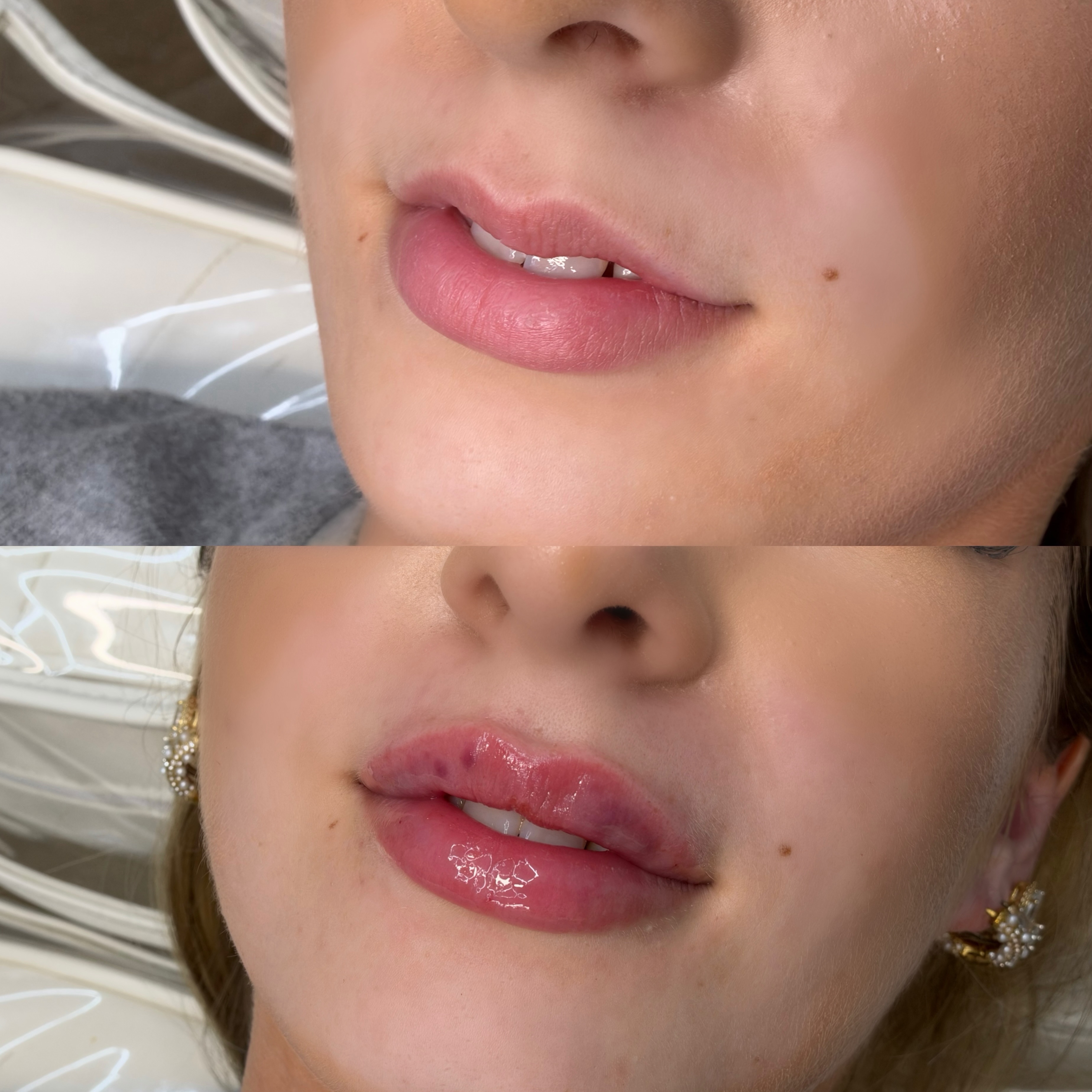 First time filler 😍 Balancing out a ‘M’ shaped lip 👄