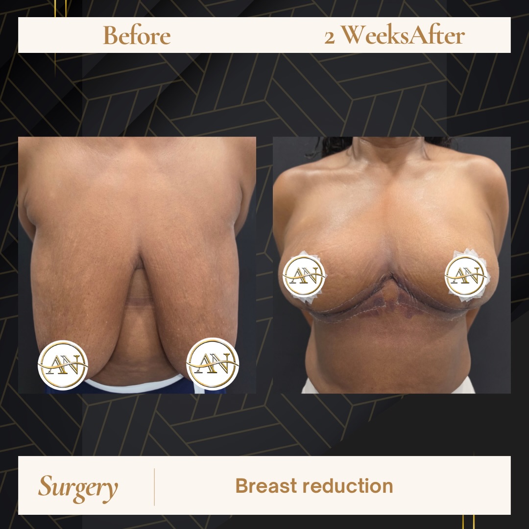 Two weeks after breast reduction, this patient is still very much in the early stages of healing.
Swelling, bruising, and some firmness are all common at this point, and the shape will continue to soften and settle over the weeks and months ahead. Even this early, many patients are already beginning to notice a difference in comfort and how their body feels day to day.
Every recovery moves at its own pace, and we’re grateful to be part of the process!
#njplasticsurgeon #nouriplasticsurgery #paramusplasticsurgeon #nourips #breastreduction