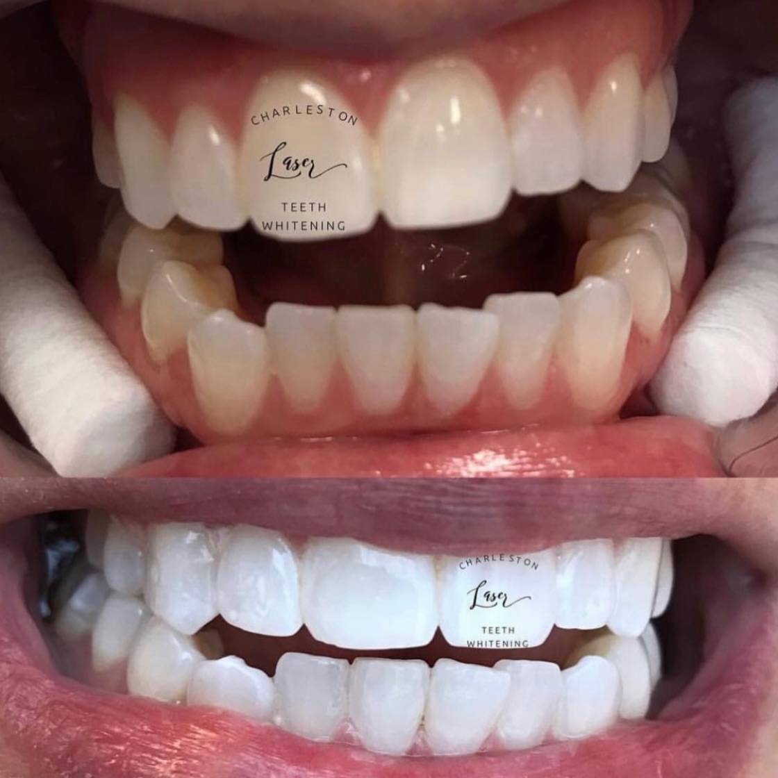 'Tis the season to be boo-tifully white. π»
Book your teeth whitening now!
www.CharlestonLaserTeethWhitening.com
#charlestonteethwhitening #charleston #charlestonsc #charlestonlaserteethwhitening mountpleasant seabrookisland mountpleasantsc kiawahisland jamesisland westashley isleofpalms downtowncharleston sullivansisland johnsisland northcharleston northcharlestonsc follybeach isleofpalms