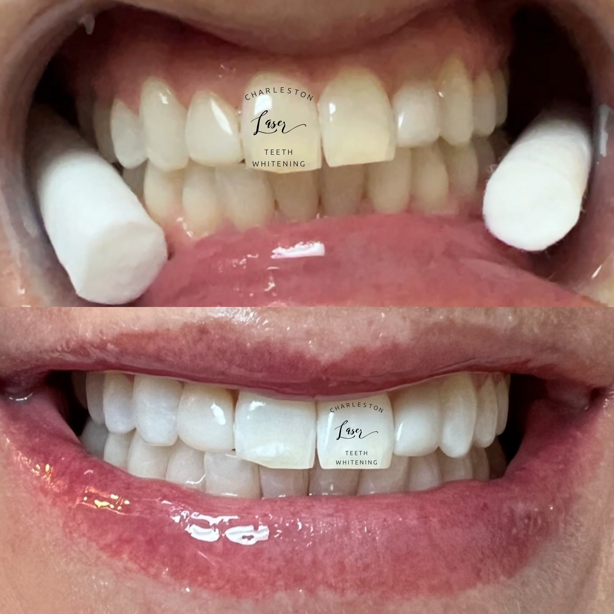I love slammed Saturdays! ποΈ
Book your teeth whitening now!
www.CharlestonLaserTeethWhitening.com
#charlestonteethwhitening #charlestonsc #charlestonlaserteethwhitening #charleston #downtowncharleston sullivansisland kiawahisland isleofpalms seabrookisland wadamalawisland edistoisland follybeach jamesisland johnsisland westashley mountpleasant northcharleston