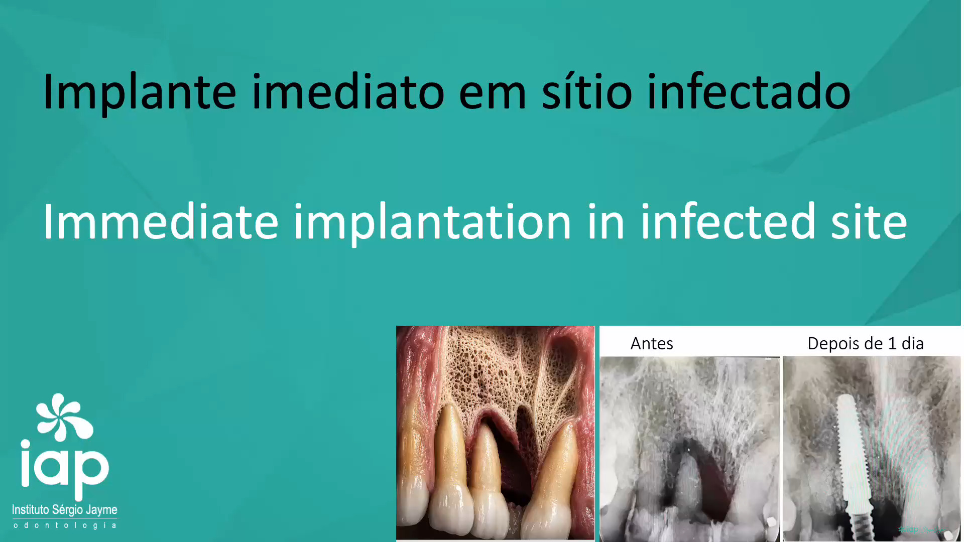 Implante imediato em sítio infectado
O implante imediato em sítio infectado pode ter excelente prognóstico quando há controle rigoroso da infecção, estabilidade primária adequada e seleção criteriosa do caso. O maior erro é acreditar que apenas “colocar o implante” resolve o processo infeccioso. O sucesso depende principalmente do desbridamento e descontaminação
Exodontia minimamente traumática
Preservar:
• tábuas ósseas
• septos
• arquitetura gengival
• papilas
Deve-se remover completamente:
• tecido de granulação
• membrana infecciosa
• biofilme
• tecido necrótico
A curetagem deve ser ampla até visualizar osso sangrante saudável.
Estabilidade primária é obrigatória
O implante deve ancorar em osso apical e/ou palatino/lingual saudável.
• torque adequado
• ausência de micromovimentação
Sem estabilidade primária → melhor abortar carga imediata ou até o implante imediato.
Posicionamento tridimensional correto
Não “seguir” o alvéolo infectado.
Frequentemente o implante deve:
• ficar mais palatino/lingual
• buscar osso intacto apical
• evitar fenestrações vestibulares
Controle do GAP
Quando houver espaço entre implante e parede alveolar:
• biomaterial particulado pode ser indicado
• membrana dependendo do defeito
• enxerto conjuntivo em casos estéticos
Antibióticoterapia
• amoxicilina
• amoxicilina + clavulanato
• clindamicina (alérgicos)
Avaliar fatores de risco sistêmicos
Maior risco de falha em:
• fumantes pesados
• diabéticos descompensados
• periodontite ativa
• higiene ruim
• imunossupressão
Dr. Sérgio Jayme
Av. Paulista, 91 Cj 402
Tel (11)5572-1283 / Cel e WhatsApp (11)94888-2000
CEP:01311-000 São Paulo-SP
Av. Rubem Berta, 1461
Tel (11)2276-2217 / Cel e WhatsApp (11)98383-3941
CEP: 04074-010 São Paulo-SP
#implante #periodontia #curso #rog #enxertoosseo #enxerto #iap #protesedental #protesedentaria #regeneracaoosseaguiada #cargaimediata #sergiojayme #sergiojaime #cienciaemvideo #implantesdentarios #implantes #implant #implants #implantdentistry #implantology #implantodontia #geistilich #nobelbiocare #iapcursos #implanteimediato #sitioinfectado