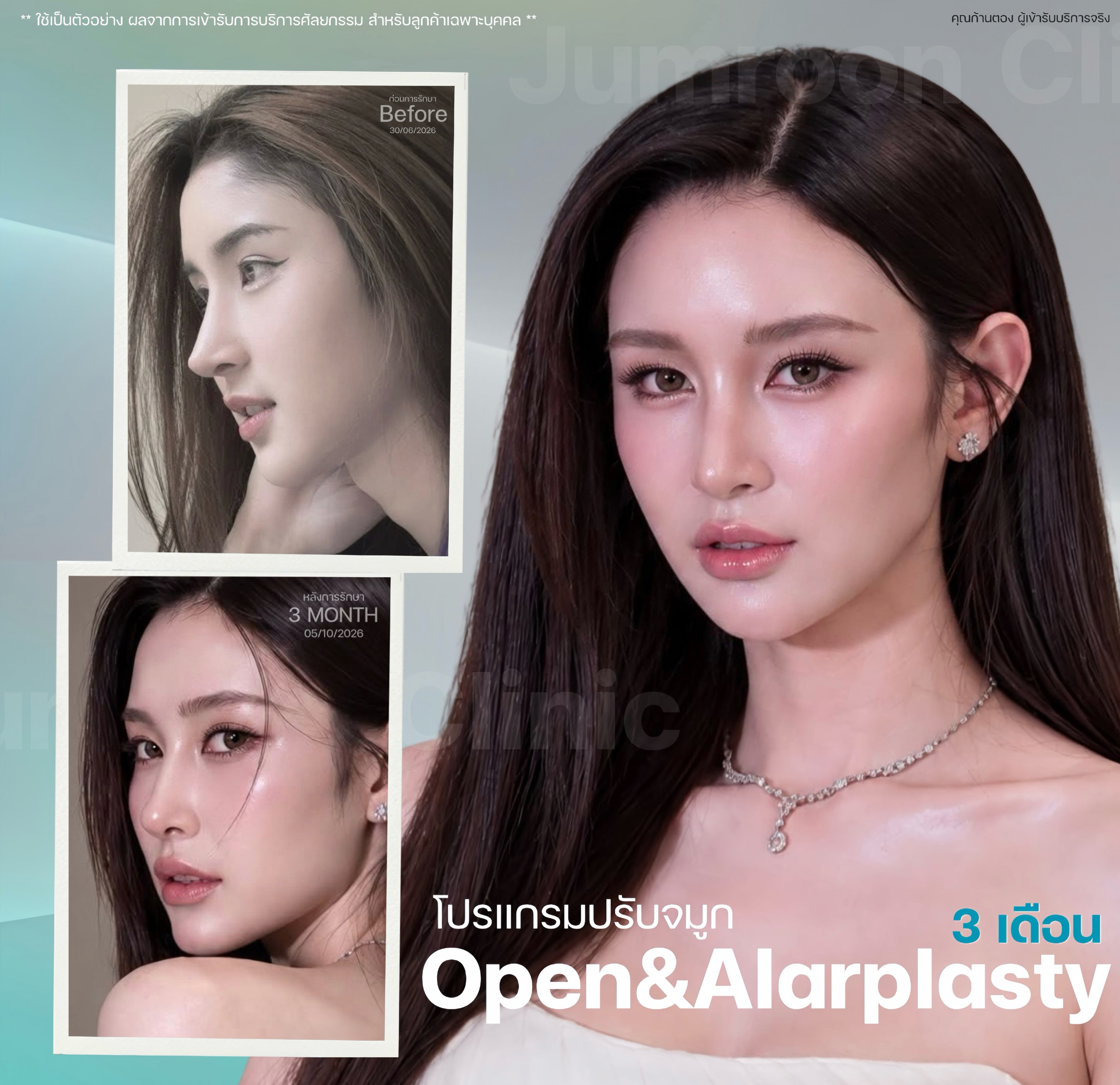 หวานขึ้น หน้าละมุนสไตล์สาวเกาหลี🇰🇷 คุณก้านตอง 🩷✨
”อาจารย์จำรูญ“ ดูแลเคสอัปเดตจมูกใหม่ 3 เดือน
✨ขอบคุณ ”คุณก้านตอง“ ลูกค้าคนสำคัญของจำรูญคลินิกที่ไว้วางใจกับอาจารย์จำรูญ!
เคสนี้อาจารย์ใช้เทคนิค Revision Open แก้ไขงานซี่โครงเดิม พร้อมเข้าไปดีไซน์แกนจมูกใหม่ให้อิ่ม ปลายอูมและเติมเต็มให้เข้ากับใบหน้า ปรับสโลป ปลายพุ่งละมุน ปรับองศาพร้อมคล้องปีกจมูกให้เล็กลง
ทรงจมูกใหม่เริ่มรัดแกน มั่นใจในทุกมุมมอง 📸✨
”สวยหวานแบบละมุน... ที่จำรูญคลินิก“
สนใจปรึกษา | นัดคิวล่วงหน้า
✅ ให้คำปรึกษาโดยหมอจำรูญ @จำรูญคลินิก
✅ ทานยาเคลิ้มหลับ
✅ บริการล้างแผล,ตัดไหม,ติดตามอาการ (After care)
✅ คุณหมอออกแบบ วิเคราะห์ใบหน้าเคสbyเคส ด้วยศาสตร์ Facial Plastic ✨
__________________________________
ข้อมูลการติดต่อ
(联系方式)
☎️โทร : 088 663 6554
☎️โทร : 082 545 5997
💚ID Line : @jumroonclinic
#เสริมจมูกโอเพ่น #เสริมจมูกOpen
#จมูกโอเพ่น #จำรูญคลินิก #นางฟ้าอ่าวไทย
จำรูญคลินิก ศัลยกรรม ศัลยกรรมตกแต่งใบหน้า จมูก โปรแกรมศัลยกรรมจมูก จมูกเนื้อเยื่อเทียม ซิลิโคนหลังหู จมูกเอียง ปรับจมูกเอียง ตัดเหนียง โปรแกรมศัลยกรรมคาง โปรแกรมยกหน้า โปรแกรมดึงหน้า ศัลยกรรมยกหน้า ศัลยกรรมใบหน้า จมูกผู้ชาย rhinoplasty นายแพทย์จำรูญแพทย์facialplastic จำรูญคลินิกสามเสน ดึงหน้า ดึงหน้าผาก ดึงขมับ ดึงแก้ม โปรโมชั่น