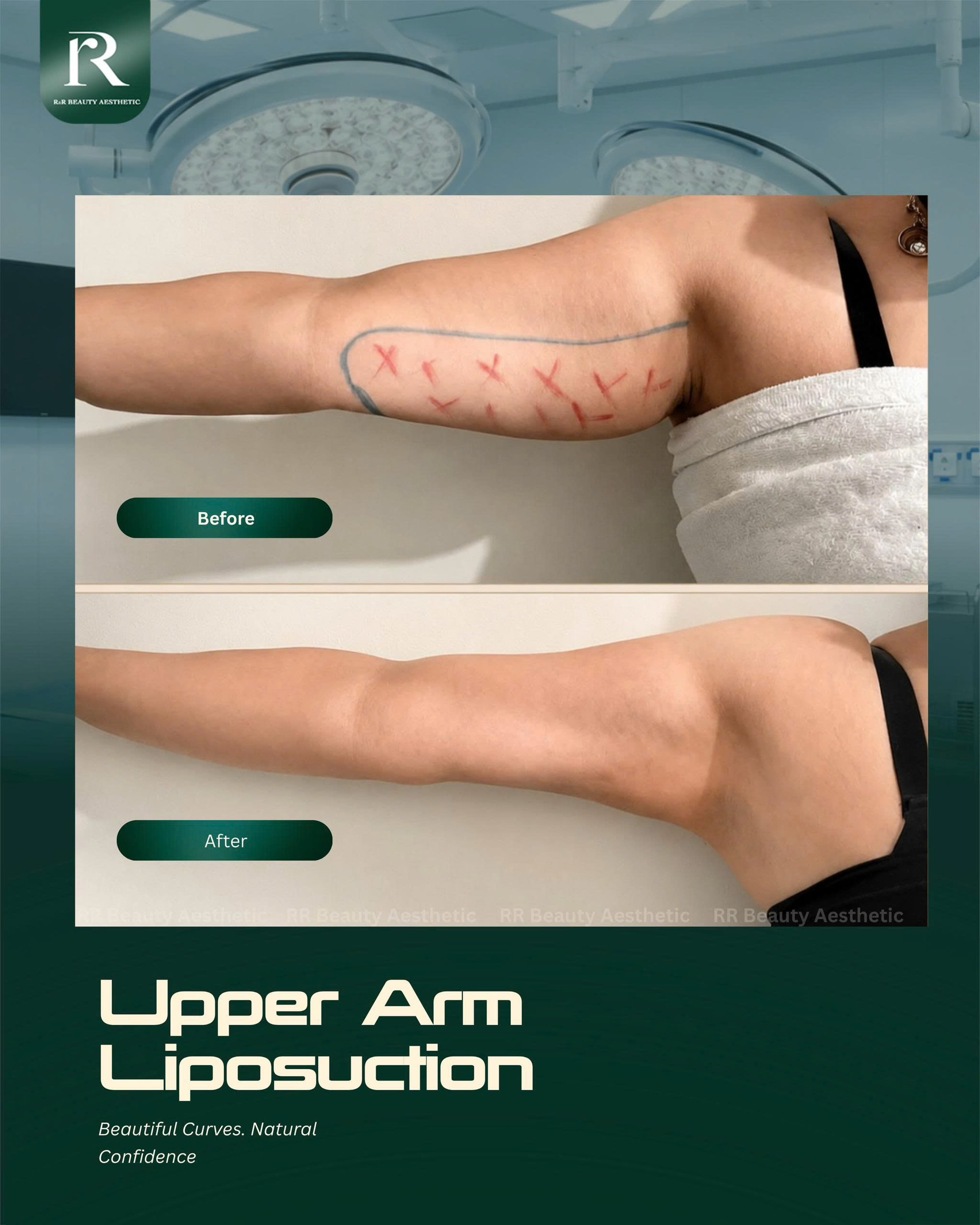 ✨ ARM LIPOSUCTION — SLIMMER ARMS. CLEANER CONTOURS.
✓ Reduces stubborn upper-arm fat
✓ Refines bulky or uneven contours
✓ Creates a slimmer arm silhouette
✓ Improves definition between the arms and shoulders
✓ Enhances overall upper-body proportions
✓ Helps clothing fit more comfortably
📩 Book Your Personalized Consultation Today
📞 Hotline: +84 777 777 787
📍 Vietnam Clinic - Plastic Surgery Center
R&R Beauty Clinic
10A Truc Duong, An Khanh Ward
Ho Chi Minh City, Vietnam
📍 Singapore Beauty Studio
R&R Beauty Studio
416 Ang Mo Kio Avenue 10
#01-985, Singapore 560416
.
.
.
#armliposuction #armlipo #upperarmlipo #slimmerarms armcontouring fatremoval bodysculpting bodycontouring cosmeticsurgery rrbeautyaesthetic
arm liposuction upper arm liposuction stubborn arm fat removal bulky arms treatment slimmer arm contour defined shoulders upper body sculpting localized fat reduction cosmetic surgery Singapore Vietnam