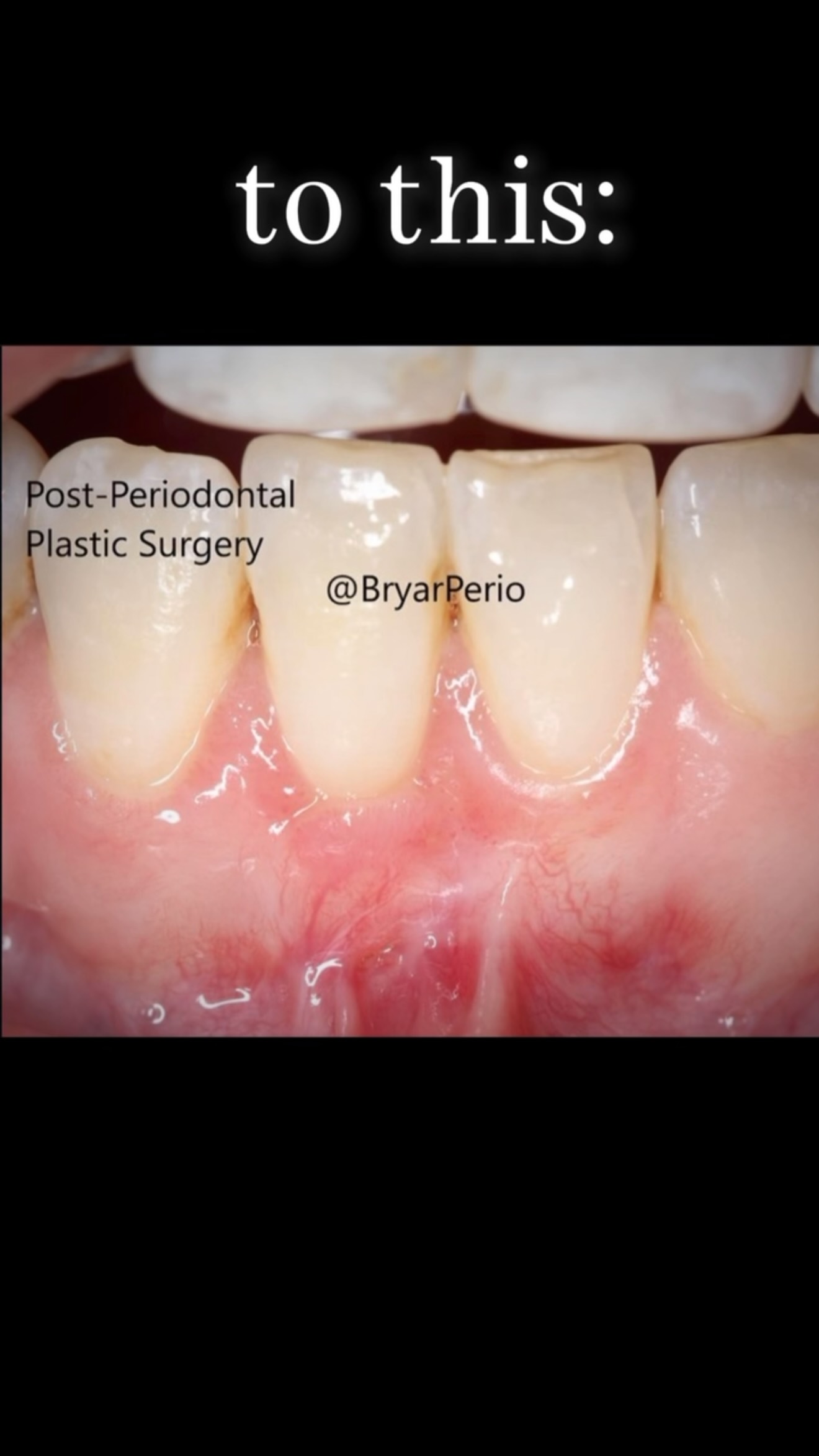 When the results speak for themselves✨
What an incredible transformation 👏🏼@bryarperio
📍Happy Smiles Dental
129-131 High Road, London, N22 6BB
#dentalsurgery #dentist #oralsurgeon #periodontist #perio