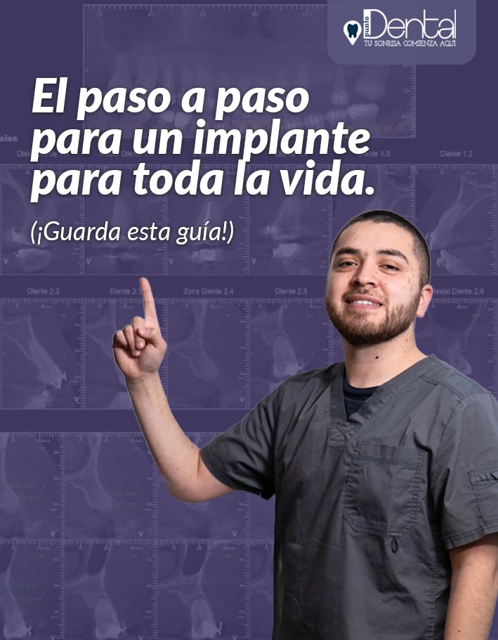 ¿Pensando en recuperar ese diente perdido?
Muchos pacientes le tienen respeto o miedo a la palabra “implante”, pero la realidad es que hoy en día es uno de los procedimientos más seguros y predecibles que realizamos en Clínica Punto Dental.
Desliza el carrusel para conocer las 5 etapas de este proceso👆🏻
💡 Nuestro secreto para el éxito: La Planificación. Un implante para toda la vida no se hace a ciegas. La clave está en la etapa previa: analizar tus radiografías 3D, evaluar la calidad de tu hueso y asegurar la salud de tus encías. Solo cuando tenemos el “mapa” perfecto, avanzamos con la colocación.
Recuperar una pieza dental no solo te devuelve la confianza para sonreír, sino que estabiliza tu mordida y protege el resto de tus dientes.
.
.
.
#implantesdentalescastro #dentistacastro