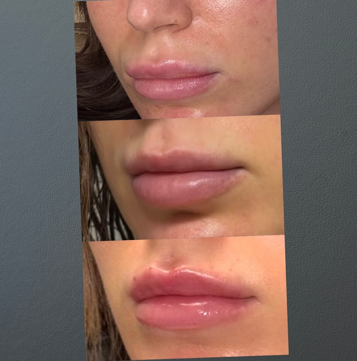 Sometimes the best lip appointment is a reset. 👄
Top: before dissolving
Middle: immediately after dissolving
Bottom: freshly rebuilt lips
I’ve been doing her lips for years, which is exactly why I wanted to share this. Even good injectors sometimes need to dissolve their own work. Over time, filler can accumulate, shift, and the natural shape of the lip can become less defined. In her before photo, you can especially see that the upper lip had started to lose its crisp shape and border.
Instead of continuing to add more filler on top, we dissolved, allowed her lips to reset, and then started fresh. ✨
The goal wasn’t necessarily bigger lips—it was better shape, cleaner definition, and a prettier overall structure.
Dissolving does not automatically mean your filler was “bad” or that something went wrong. Sometimes, after years of maintaining your lips, it’s simply the best way to get them looking their best again.
And yes—even as the injector who did the original work, I will always choose to dissolve over endlessly adding more product.
Don’t be afraid of the reset. Sometimes starting over is exactly what your lips need. 🤎