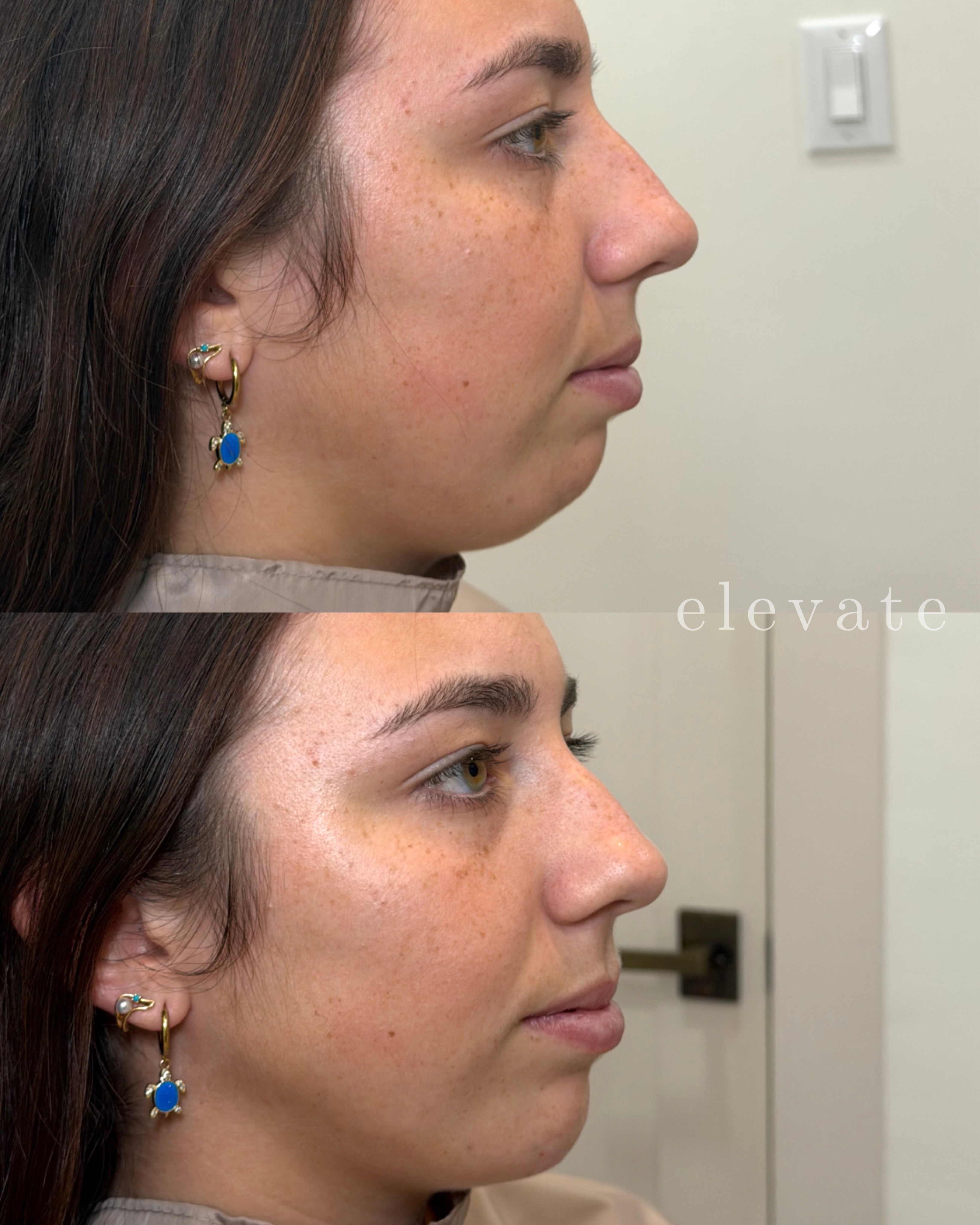 Chin filler to create a beautifully balanced profile. 🤍
Treatment provider:
@injector_erinbrown