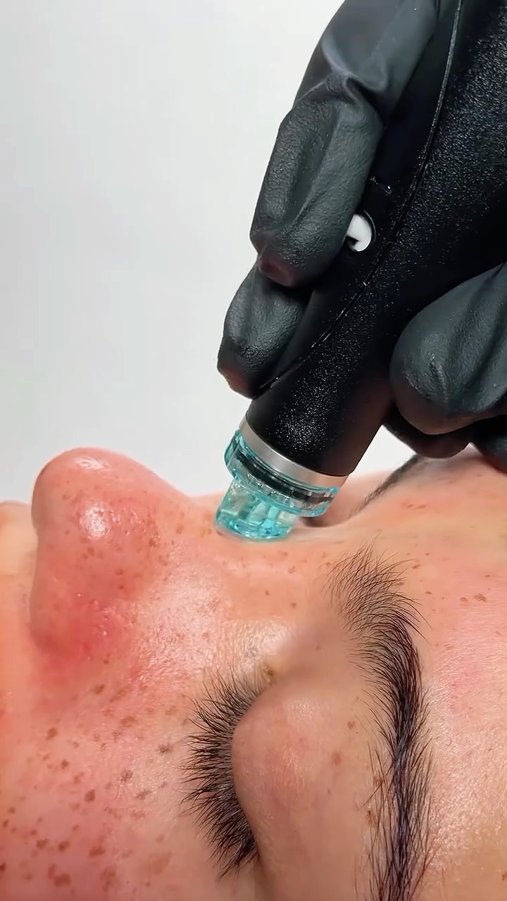 Give your skin the reset it deserves 💧 A Hydrafacial deeply cleanses, unclogs pores, hydrates, and leaves your skin glowing after just one session.
#HydrafacialQatar #HydrafacialDoha #BeautyBoxQatar #FacialDoha #GlowingSkinQatar
