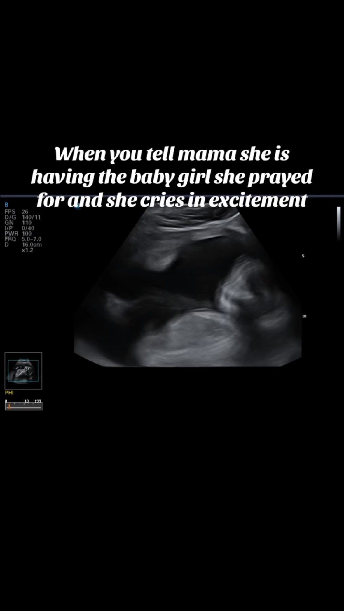 Some moments are just too special for words. 🥹💚 Watching mama hear “it’s a baby girl” after praying for her is everything.
#babygirl #electiveultrasound #sweetpeafamily