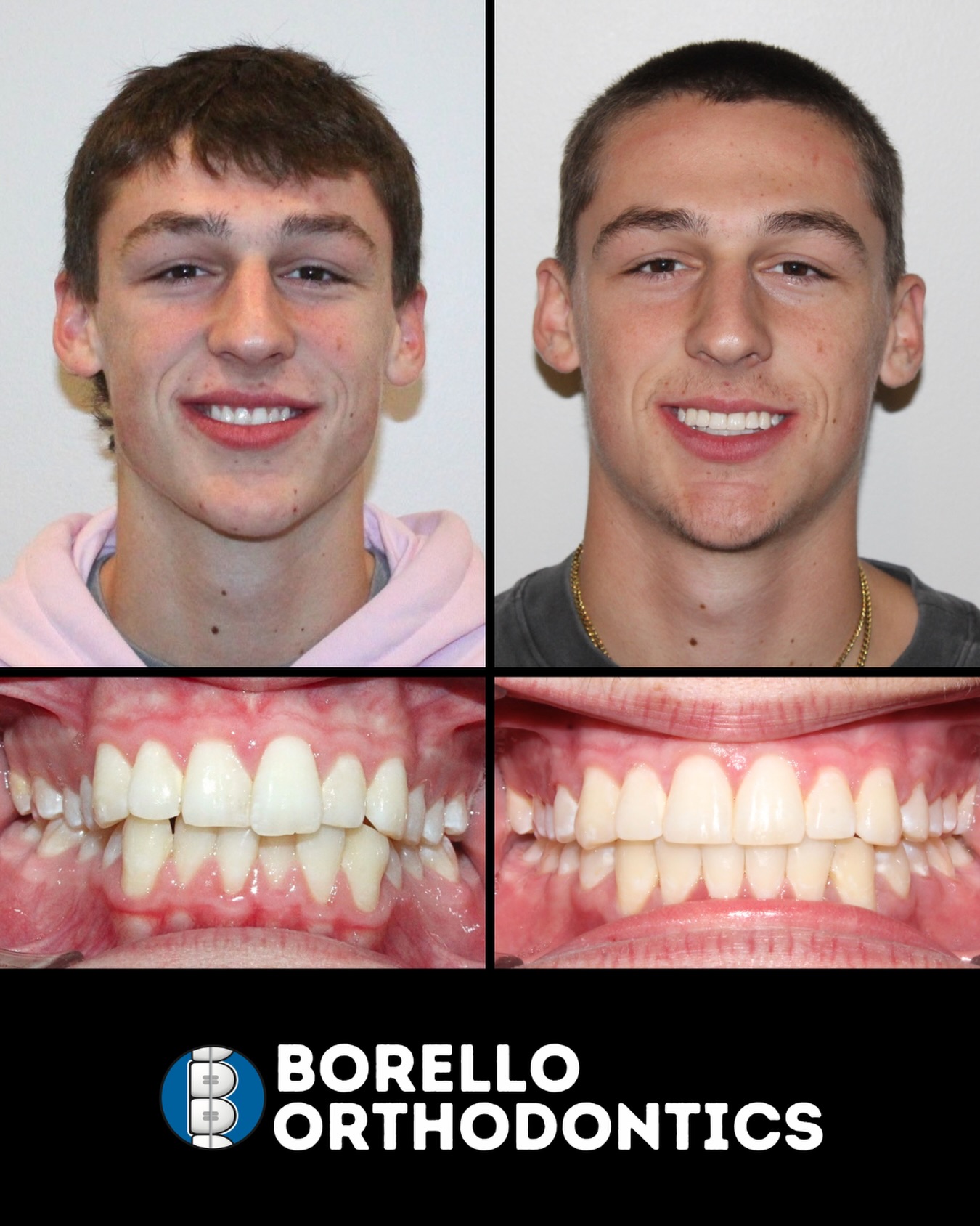 What a difference a couple of years makes! 🤩 It’s been so fun watching Cooper grow throughout his treatment, and we’re proud of the confident smile he’s leaving with. Congrats, Cooper!