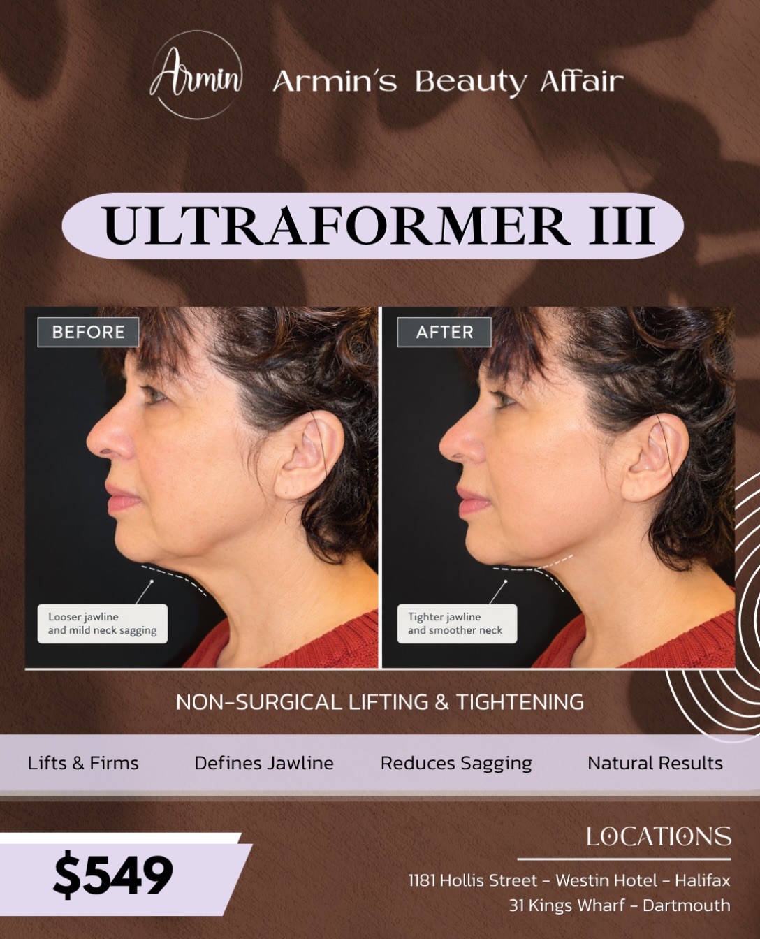 ✨ Ready for a more defined jawline? Meet Ultraformer III HIFU! ✨
Looking for firmer, tighter-looking skin without surgery?
At Armin’s Beauty Affair SPA, Ultraformer III HIFU uses advanced focused ultrasound technology to help lift and tighten the skin, enhance jawline definition, and improve the appearance of mild sagging around the lower face and neck.
🤍 Why clients love Ultraformer III:
• A more defined-looking jawline
• Firmer, tighter-looking skin
• Improved appearance of the lower face and neck
• Non-surgical treatment with minimal downtime
Real clients. Real treatment journeys. Beautifully natural-looking results. ✨
Your skin deserves a little extra love. Book a consultation with our team to find out if Ultraformer III HIFU is right for you!
📍 Visit Armin’s Beauty Affair Medi SPA in Halifax or Dartmouth.
📩 DM us to learn more or book your consultation!
#ArminsBeautyAffair #UltraformerIII #HIFU #SkinTightening #JawlineContouring HalifaxBeauty DartmouthNS HalifaxMediSpa