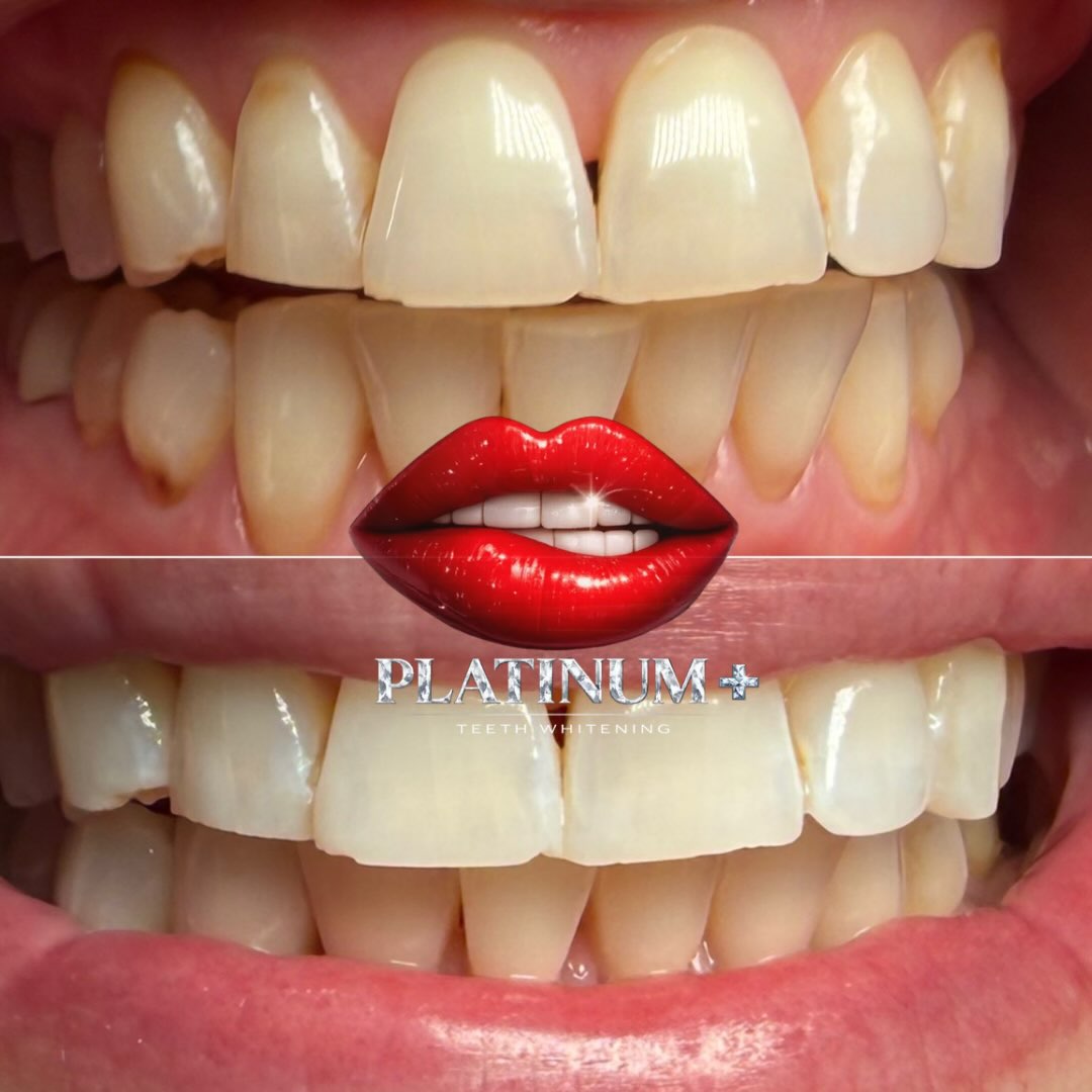 ☀️✨ SATURDAY MORNING SMILE TRANSFORMATION! ✨🦷
Started this Saturday bright and early in Fairfield, NJ, bringing PLATINUM+ results right to the Target parking lot! ❤️💋
Another smile brighter, more confident, and ready for the weekend! 😁✨
🚐💎 PLATINUM+ Teeth Whitening — Your luxury mobile whitening experience, wherever you are!
📍 Fairfield, New Jersey
💋 Brighter smiles. Same lifestyle. PLATINUM results.
📲 Book your VIP whitening experience today!
#PlatinumPlusTeethWhitening #BeforeAndAfter #TeethWhiteningNJ #FairfieldNJ #MobileTeethWhitening SaturdayMorning SmileTransformation PlatinumResults NewJerseySmallBusiness